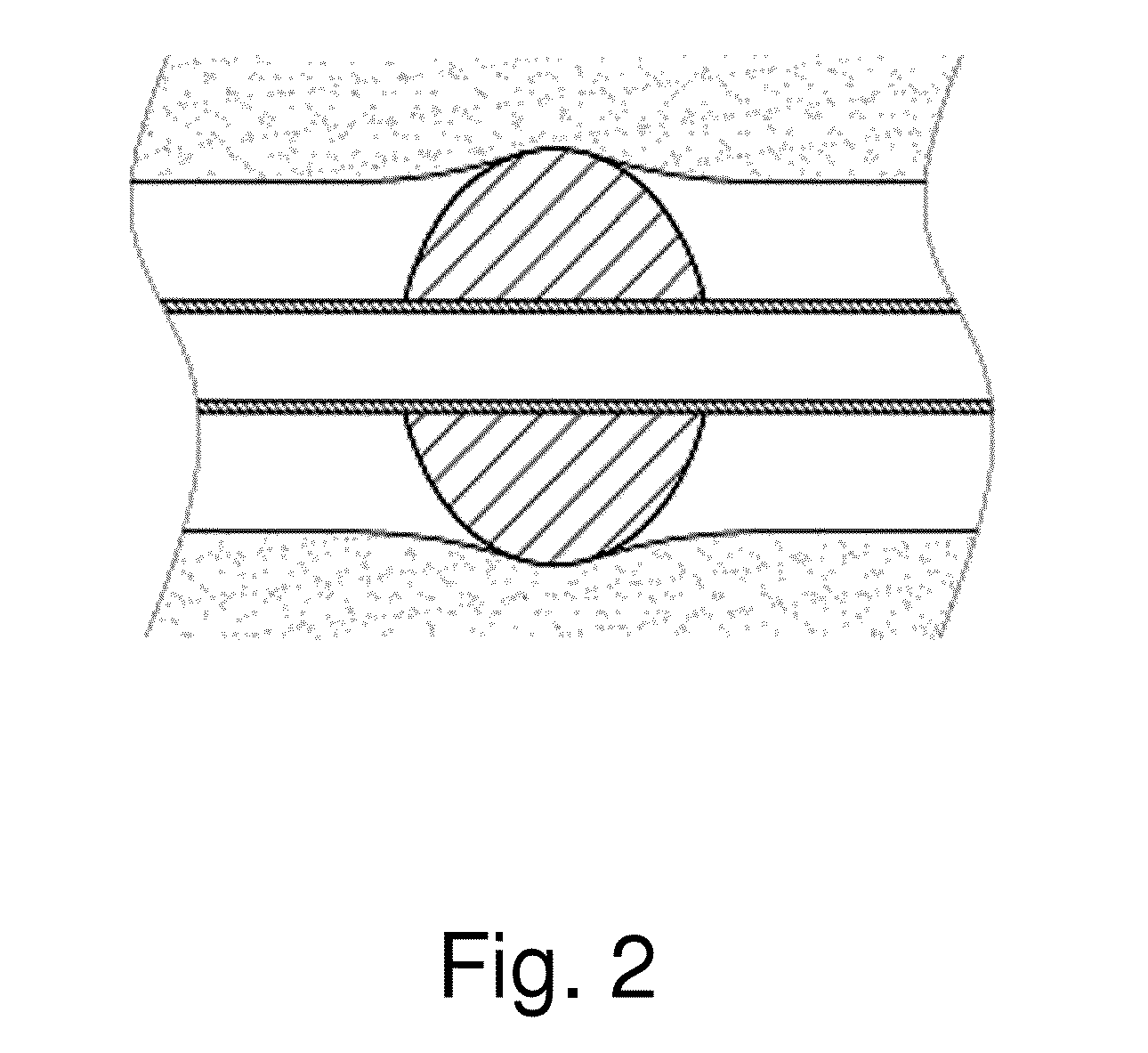 Endotracheal tube comprising corrugated cuff