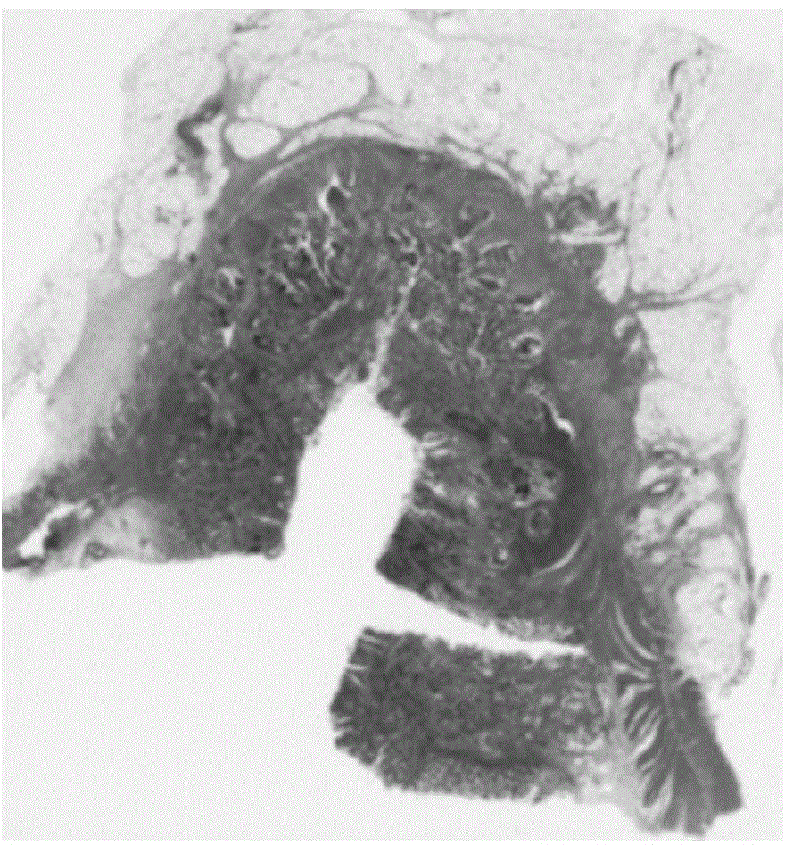 Automatic fast segmenting method of tumor pathological image