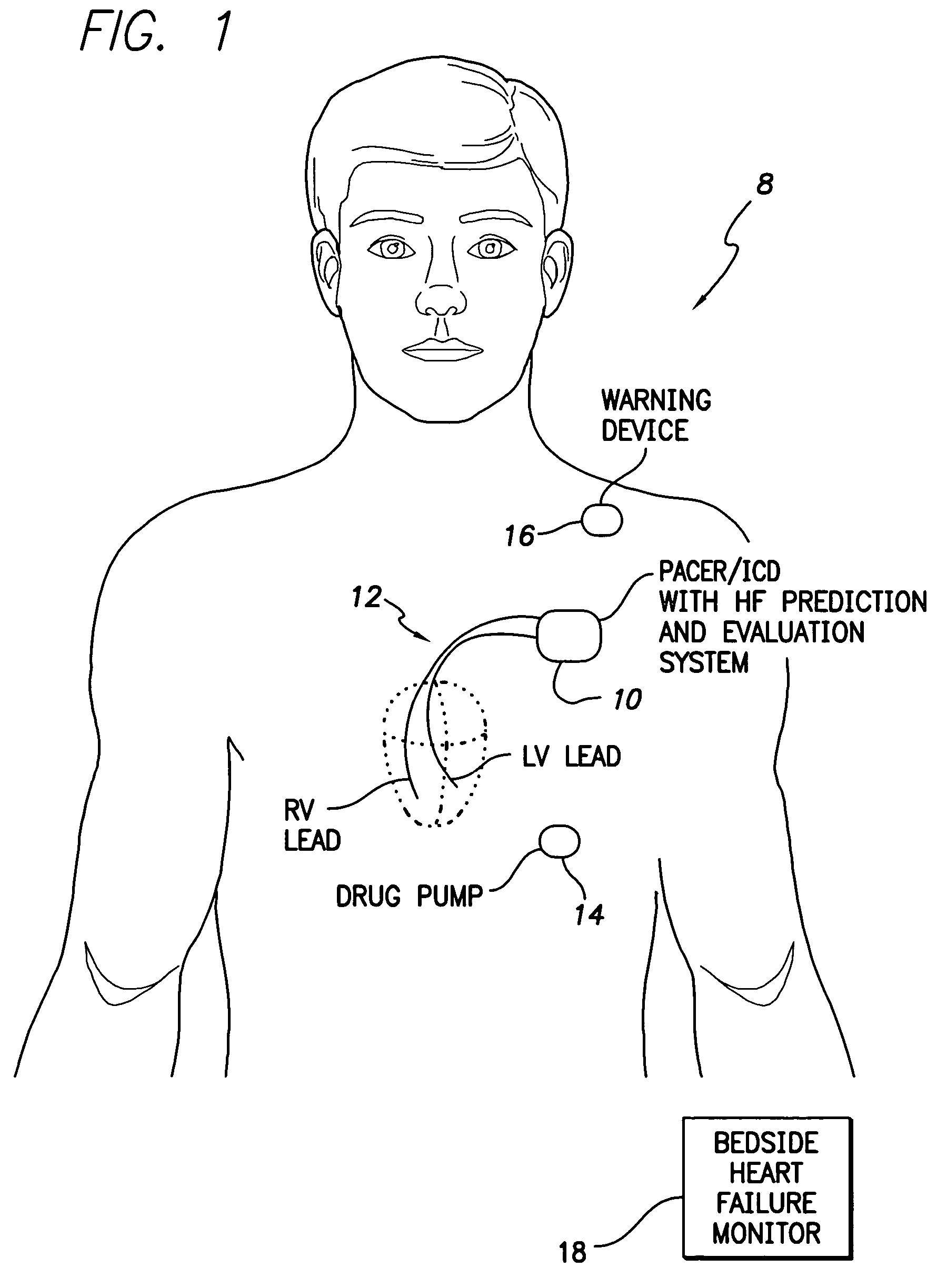System and method for predicting a heart condition based on impedance values using an implantable medical device