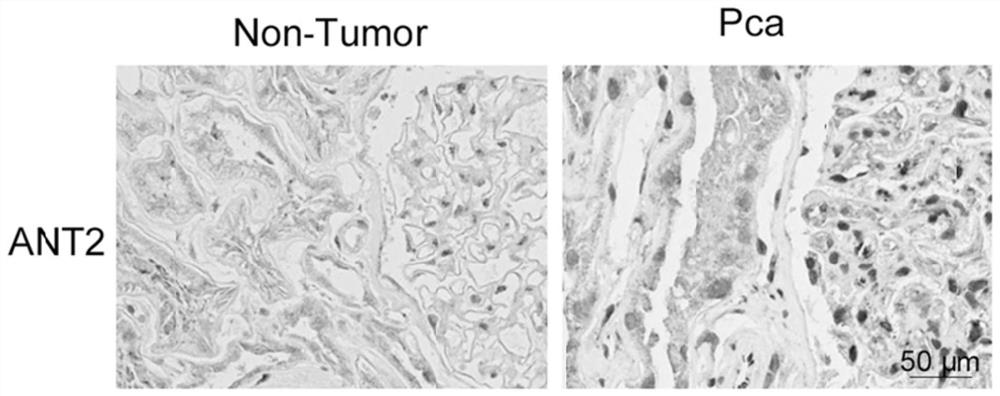 A pharmaceutical composition for preventing and treating cancer and its application