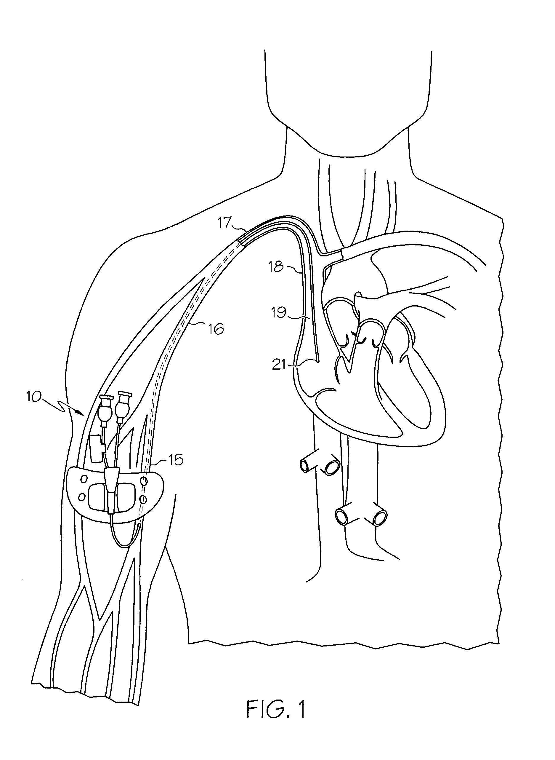 Catheter with position indicator