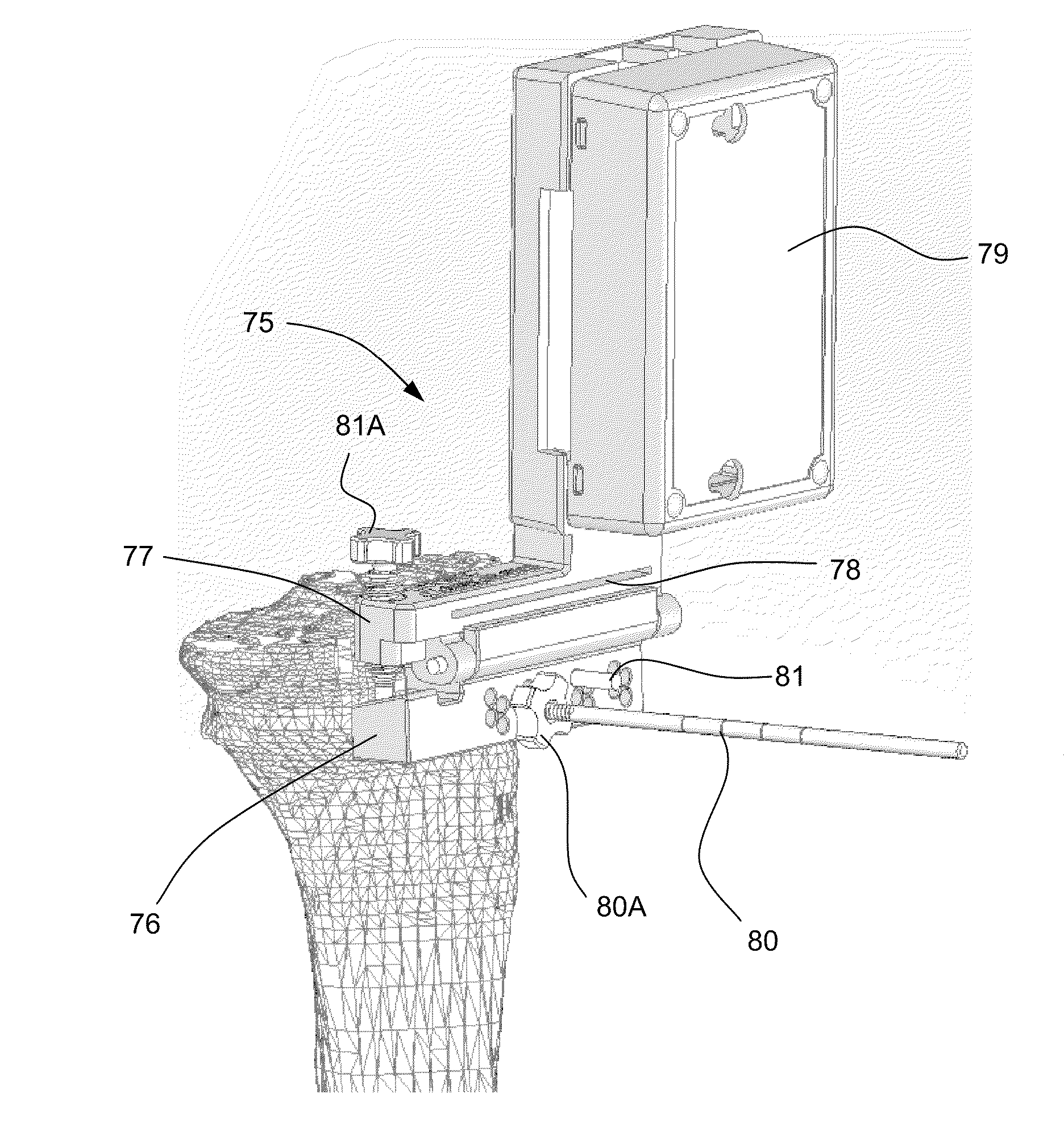 Method and system for planning/guiding alterations to a bone