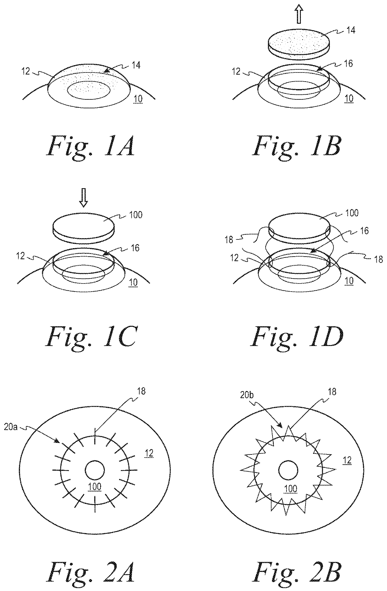 Systems and methods for corneal transplants