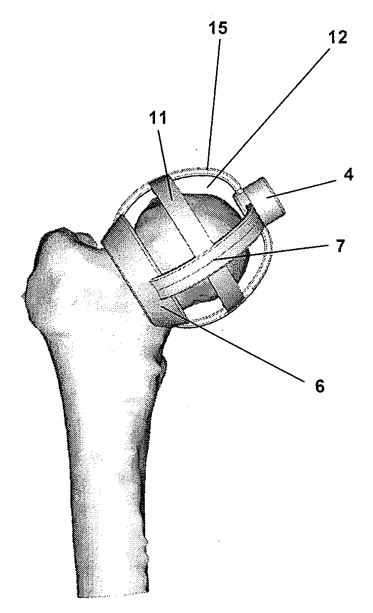 Surgical guiding tool, methods for manufacture and uses thereof