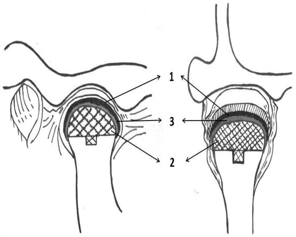 Biological condyle of temporomandibular joint based on tissue engineering related technology