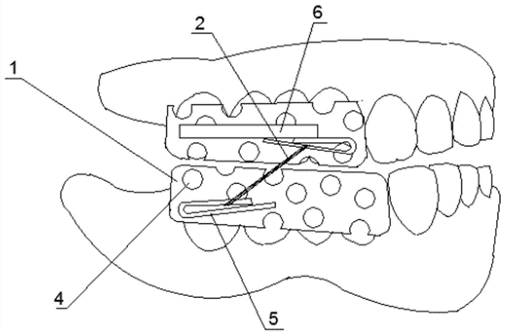 Orthodontic method and device