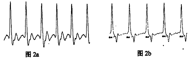 Radial artery pulse wave based cardiovascular function parameter detection and analysis method and detection device