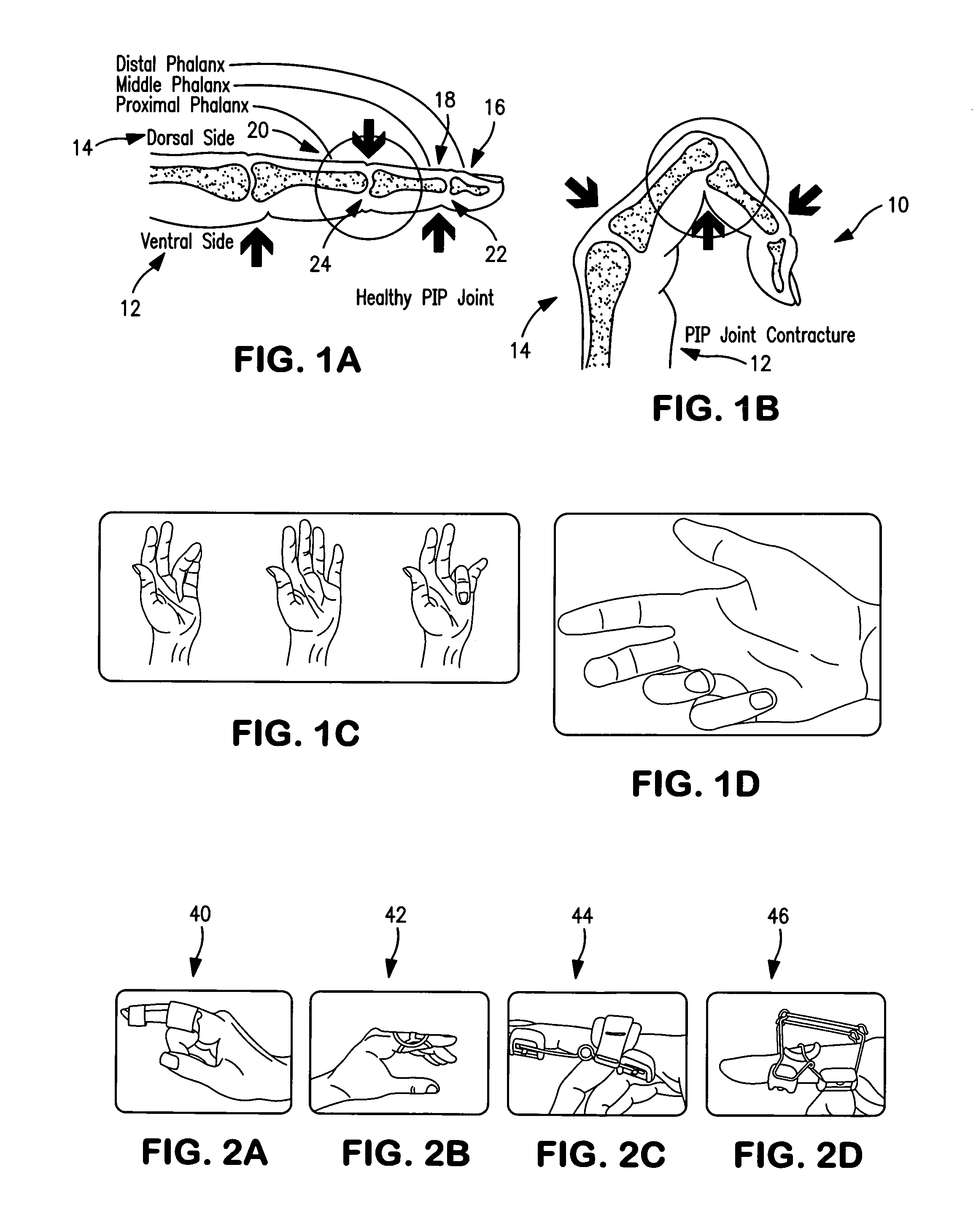 Splint for treatment of musculoskeletal injury of the hand