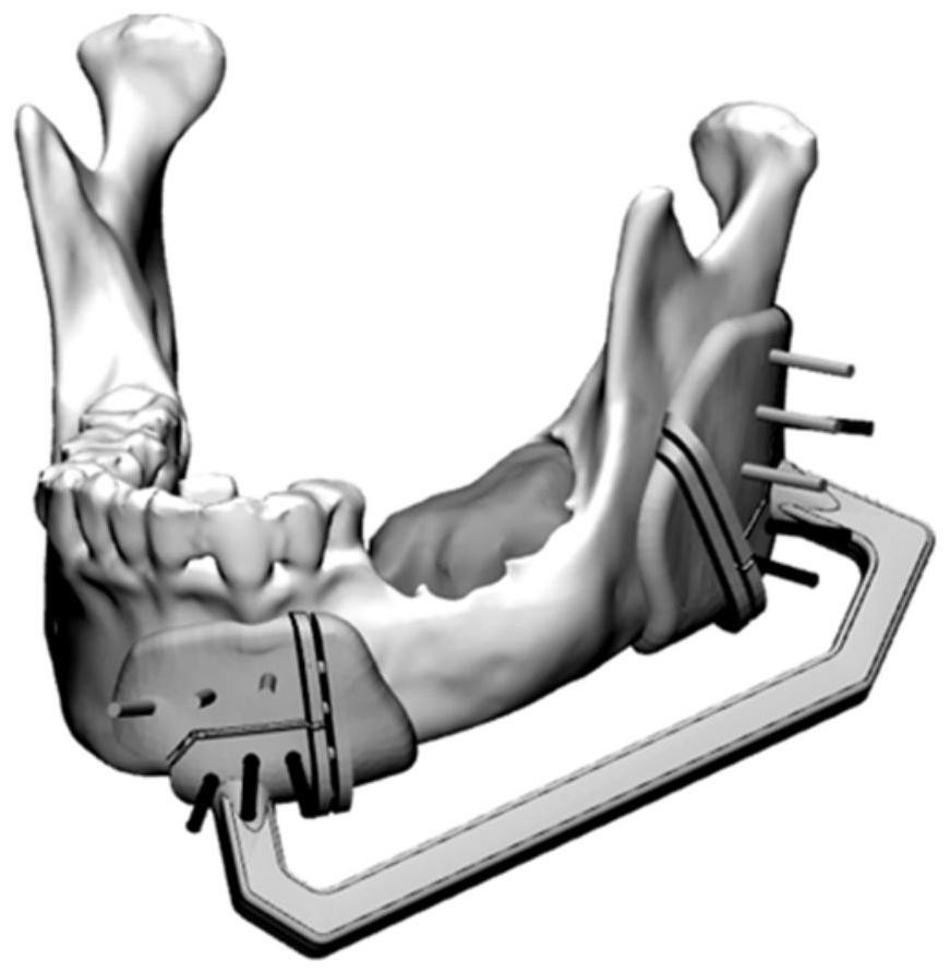 An integrated mandibular osteotomy external fixation device and using method