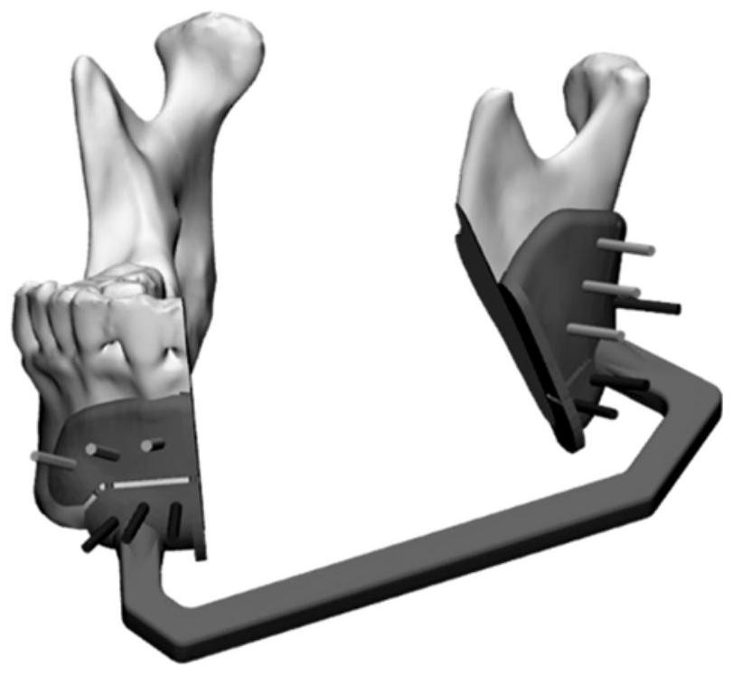 An integrated mandibular osteotomy external fixation device and using method