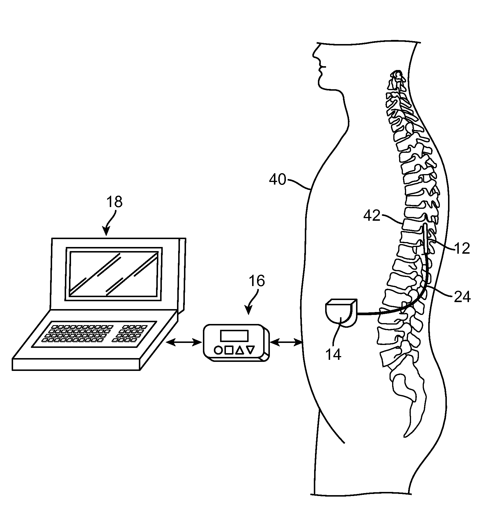 Method for achieving low-back spinal cord stimulation without significant side-effects