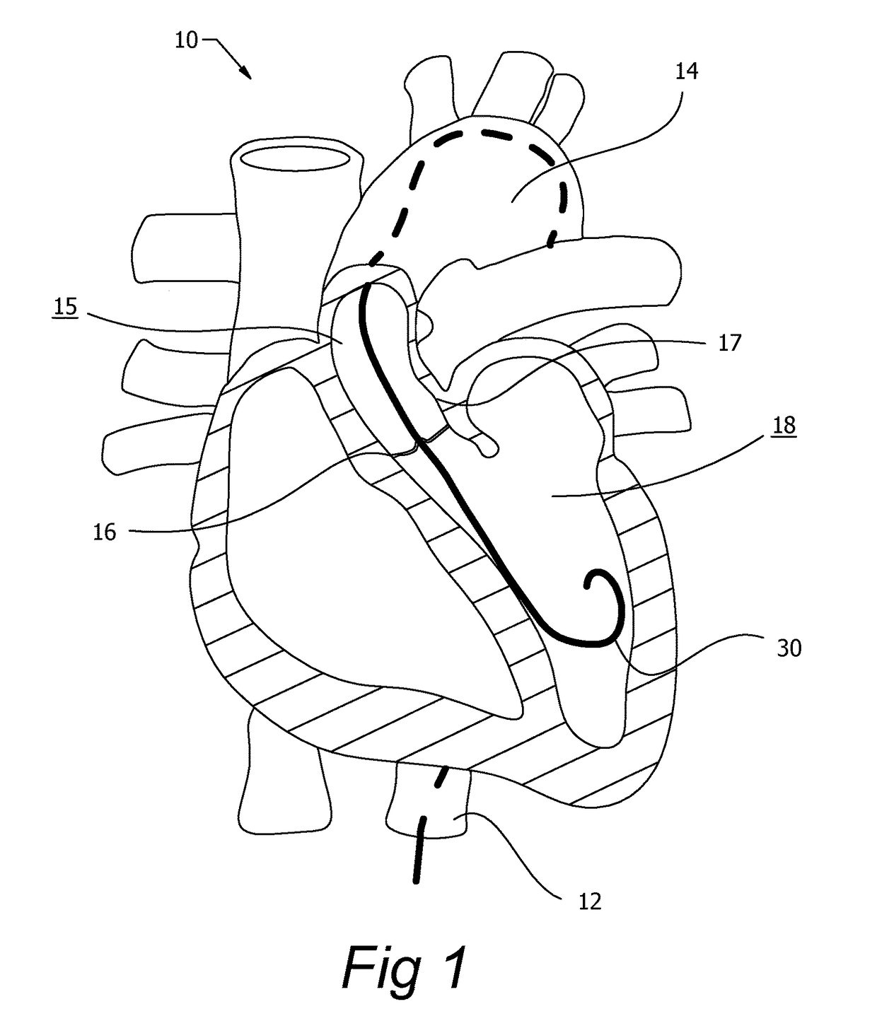 Integrated catheter guide wire control device
