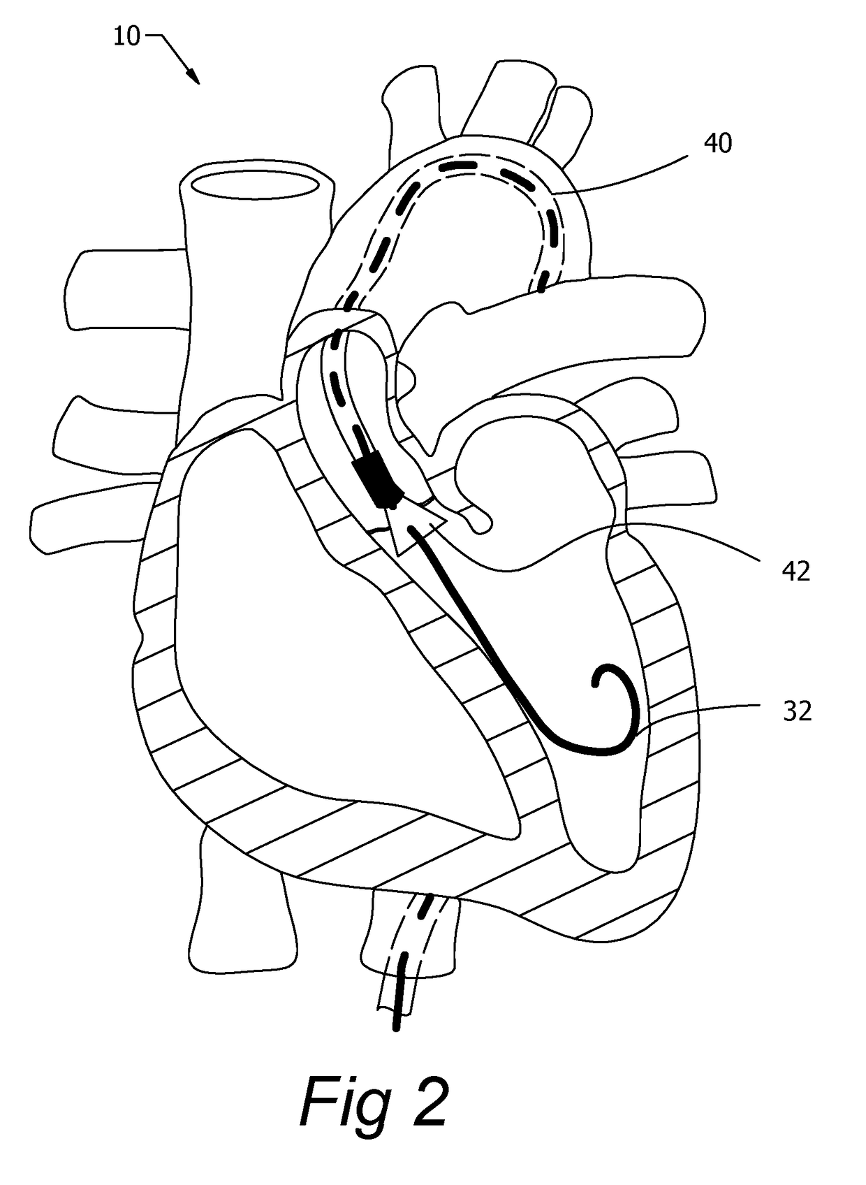 Integrated catheter guide wire control device