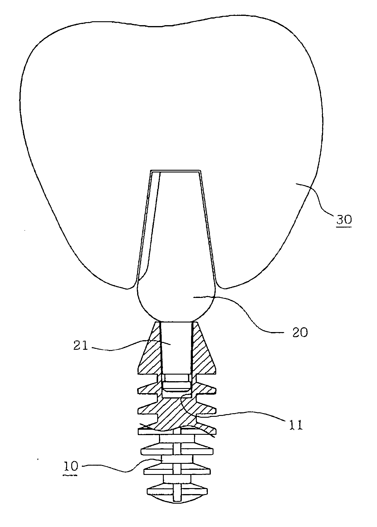 Abutment of implant system