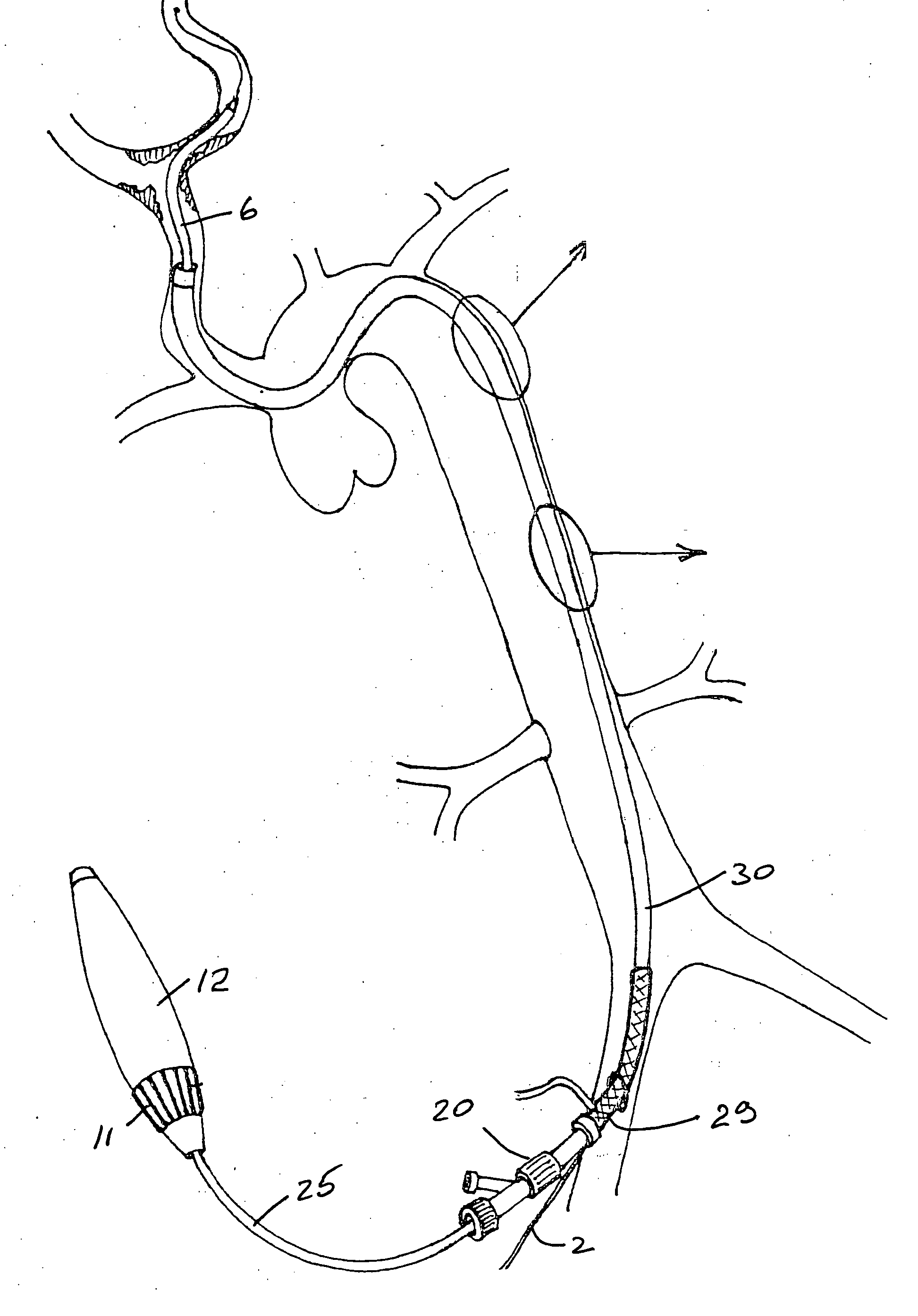 Stent delivery and deployment system