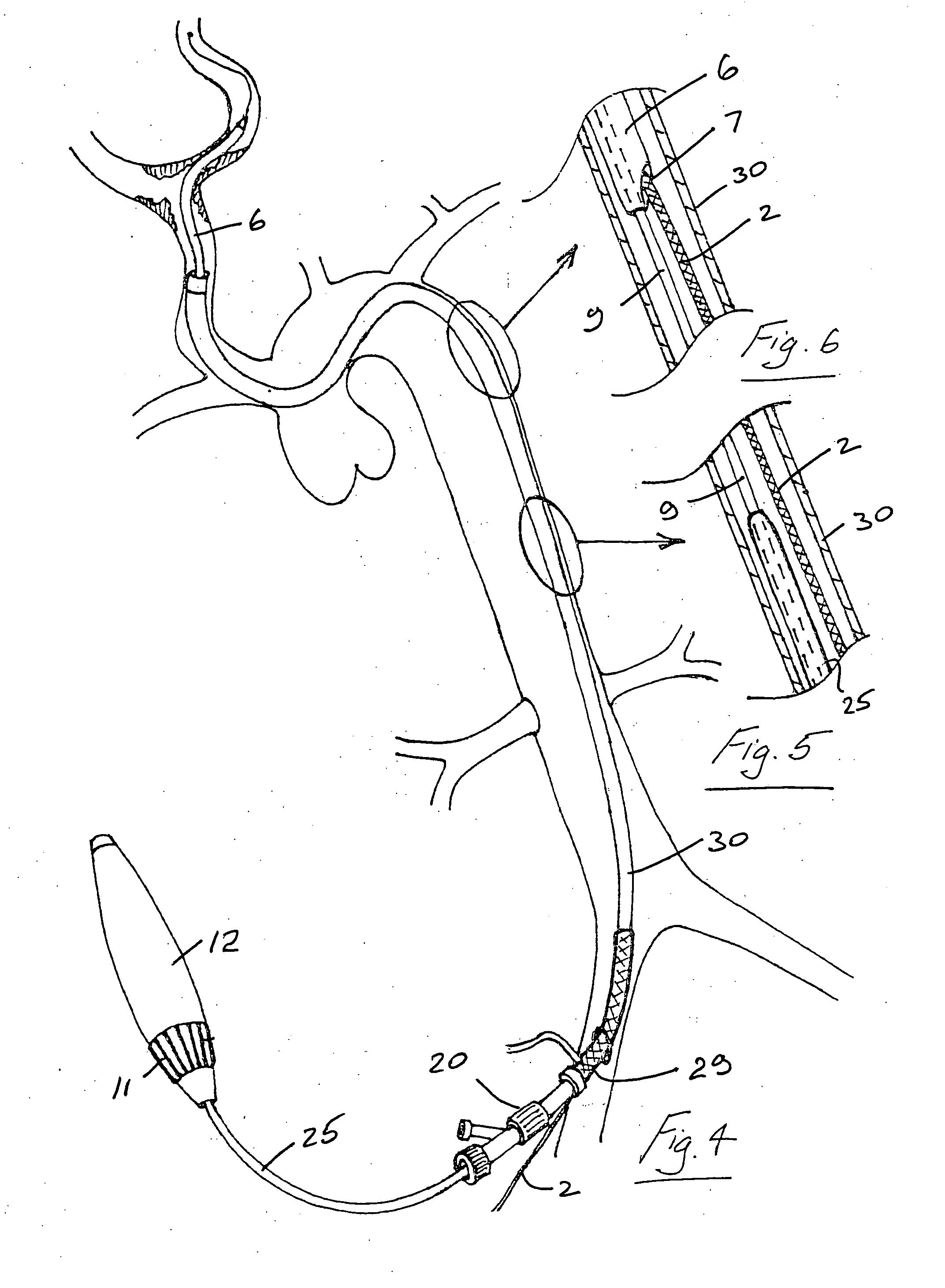 Stent delivery and deployment system