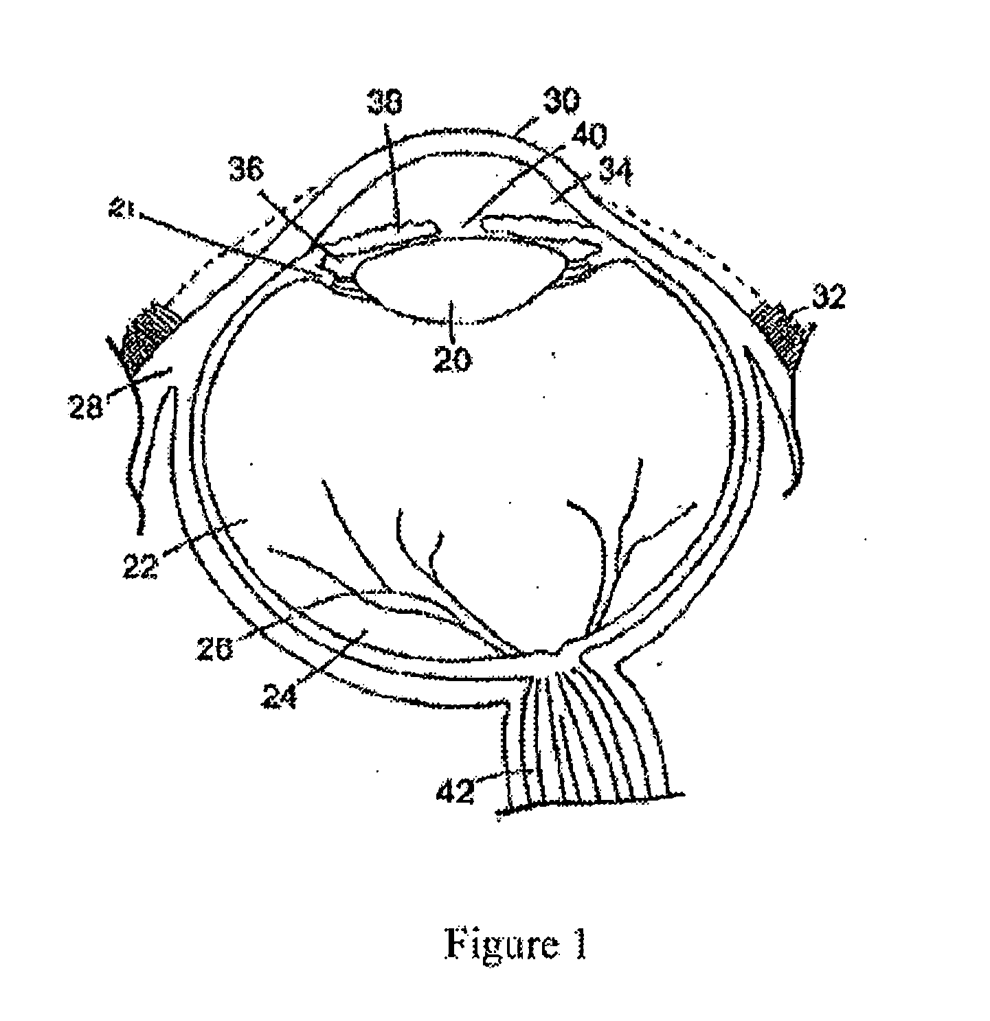 Biodegradable ocular implants and methods for treating ocular conditions