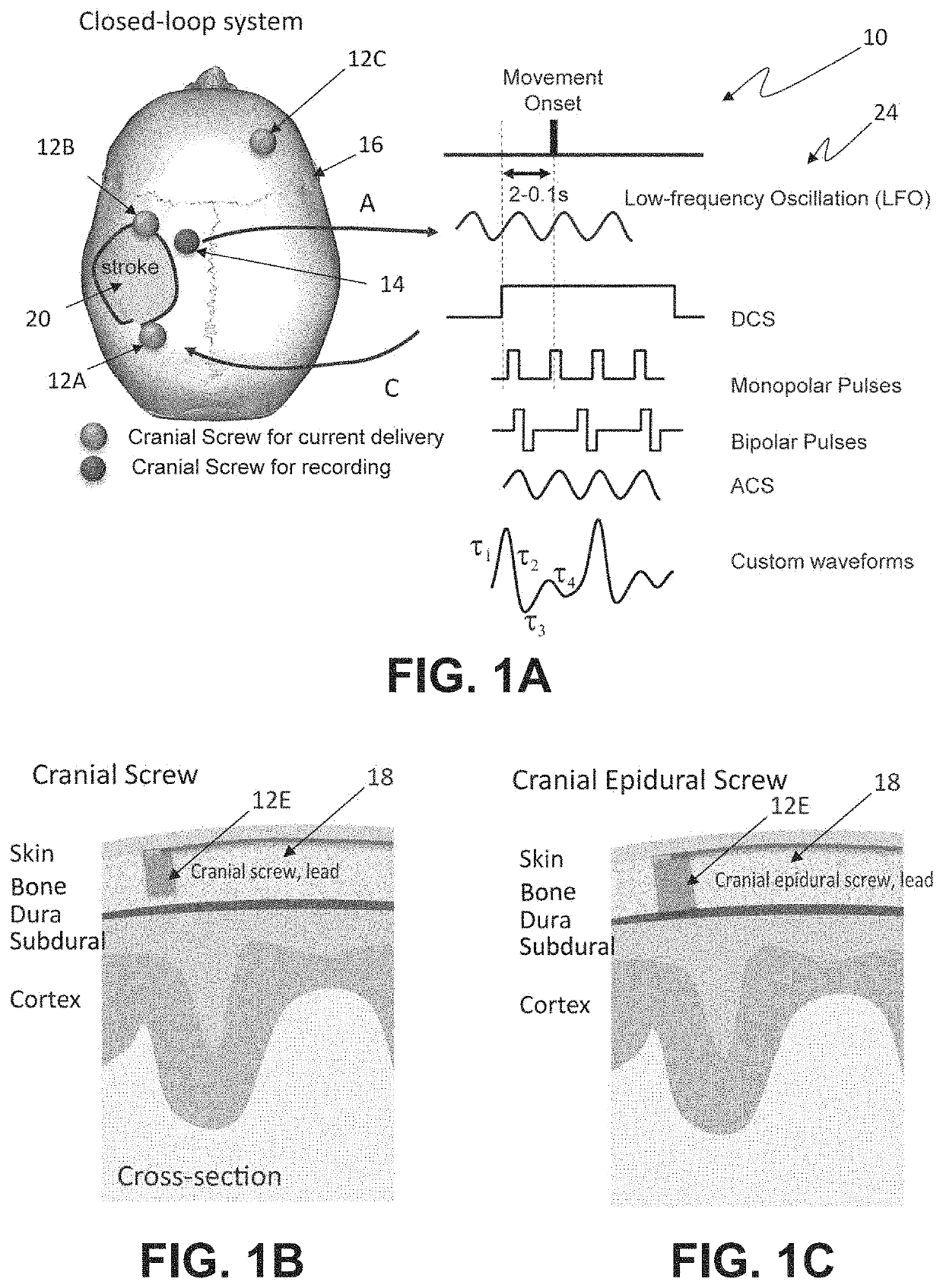 Systems Methods And Devices For Closed-Loop Stimulation To Enhance Stroke Recovery