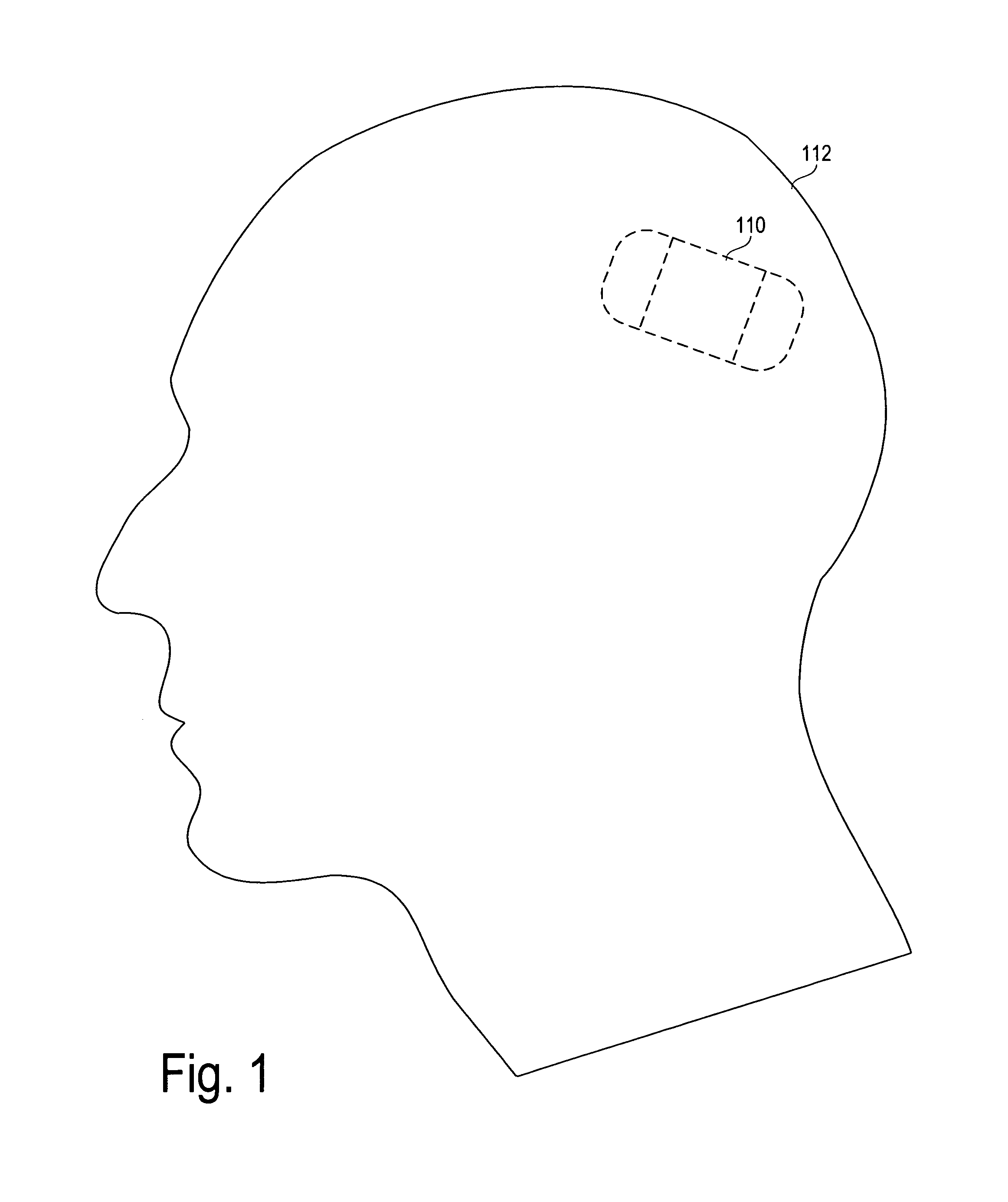 Seizure sensing and detection using an implantable device