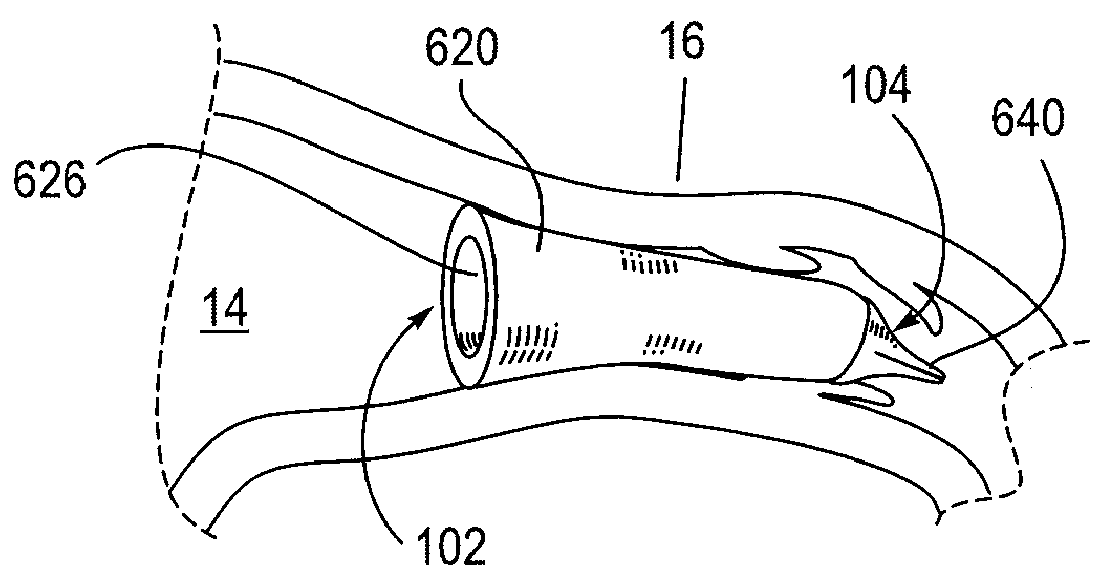 Methods, Devices, Kits and Systems for Defunctionalizing the Cystic Duct