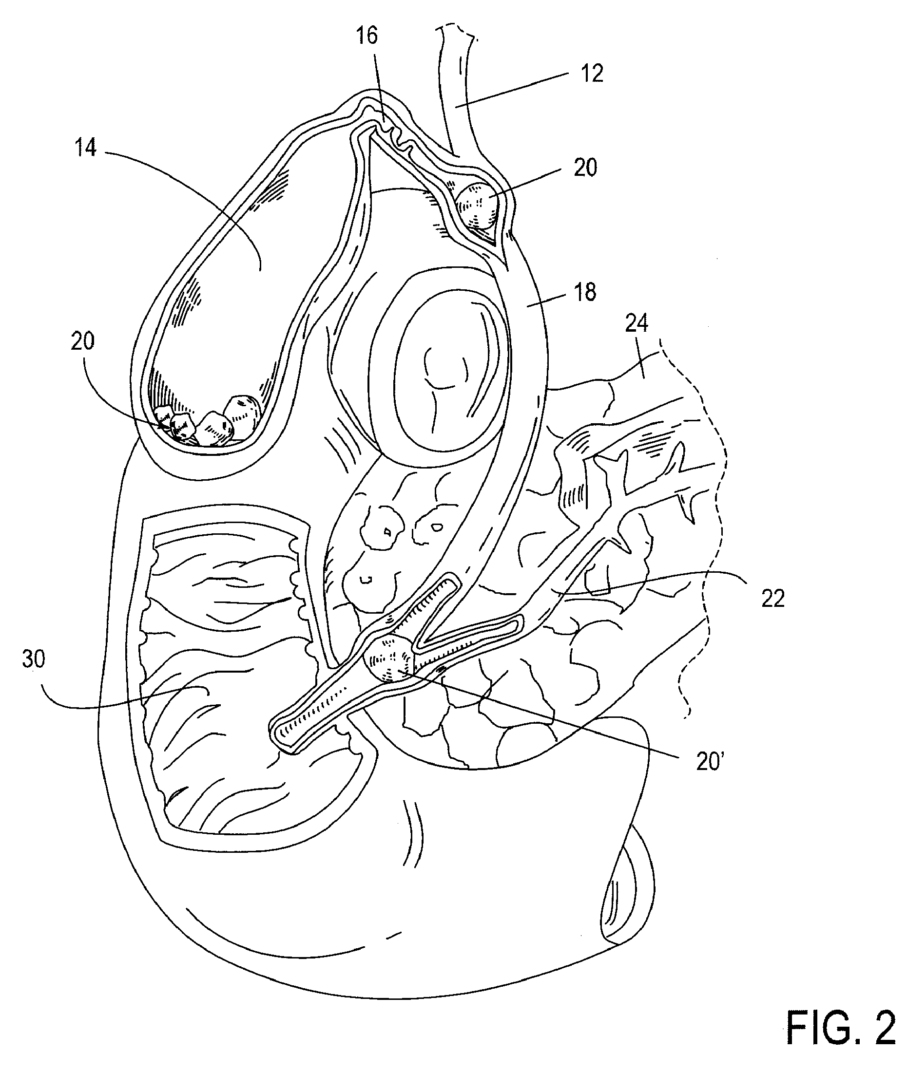 Methods, Devices, Kits and Systems for Defunctionalizing the Cystic Duct