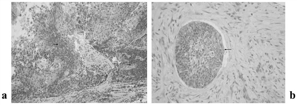 A set of lamp primers ck19-33 for rapid detection of lymph node metastasis in head and neck squamous cell carcinoma