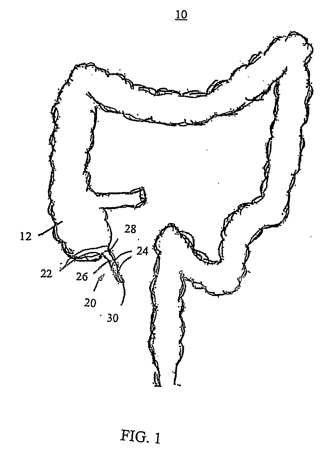 Apparatus and method for colonoscopic appendectomy