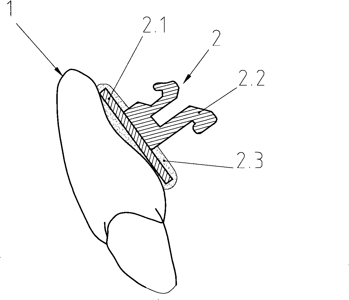 Method for producing individual bracket from preformed lingual bracket and products thereof