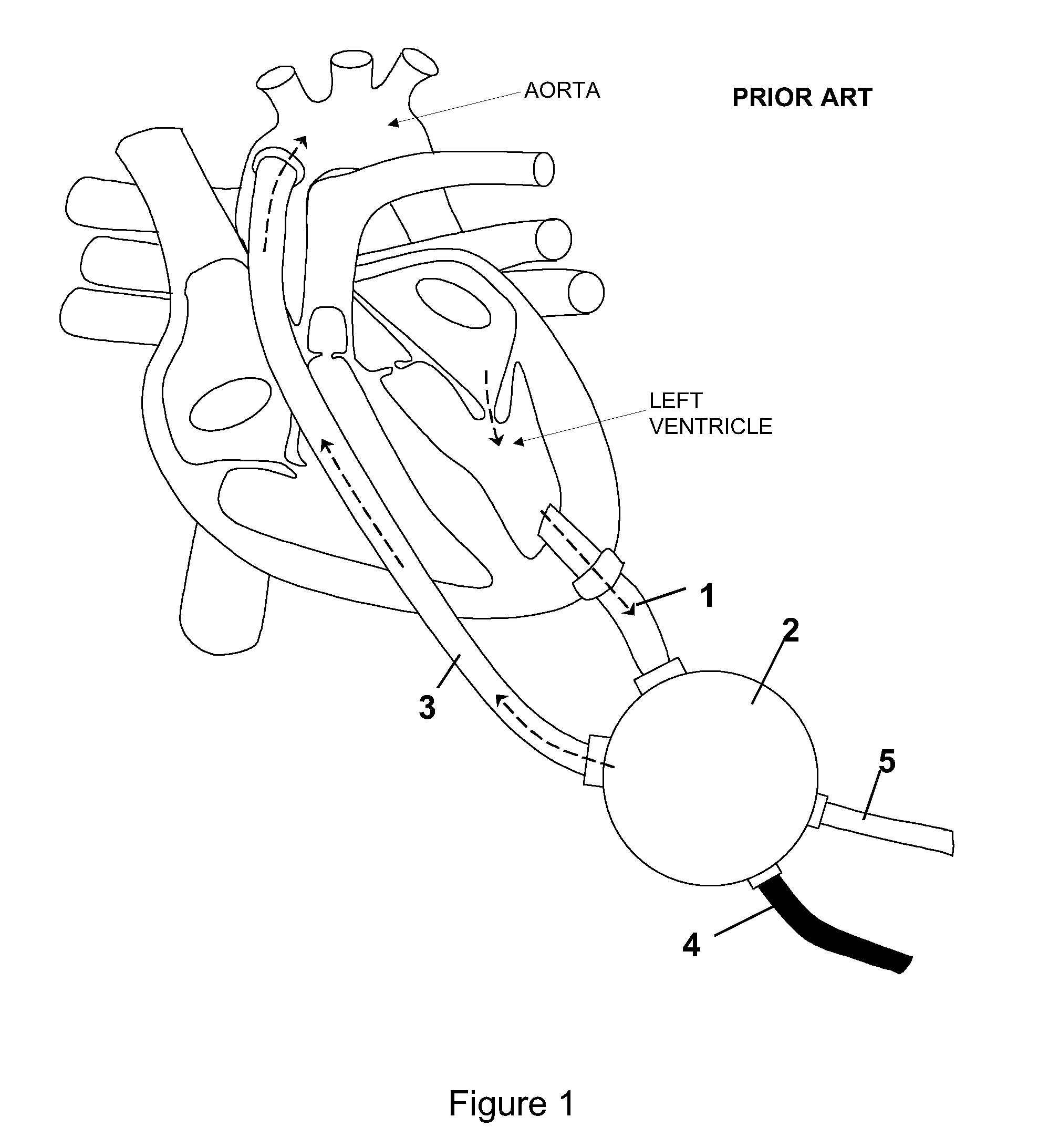 Heart assist device