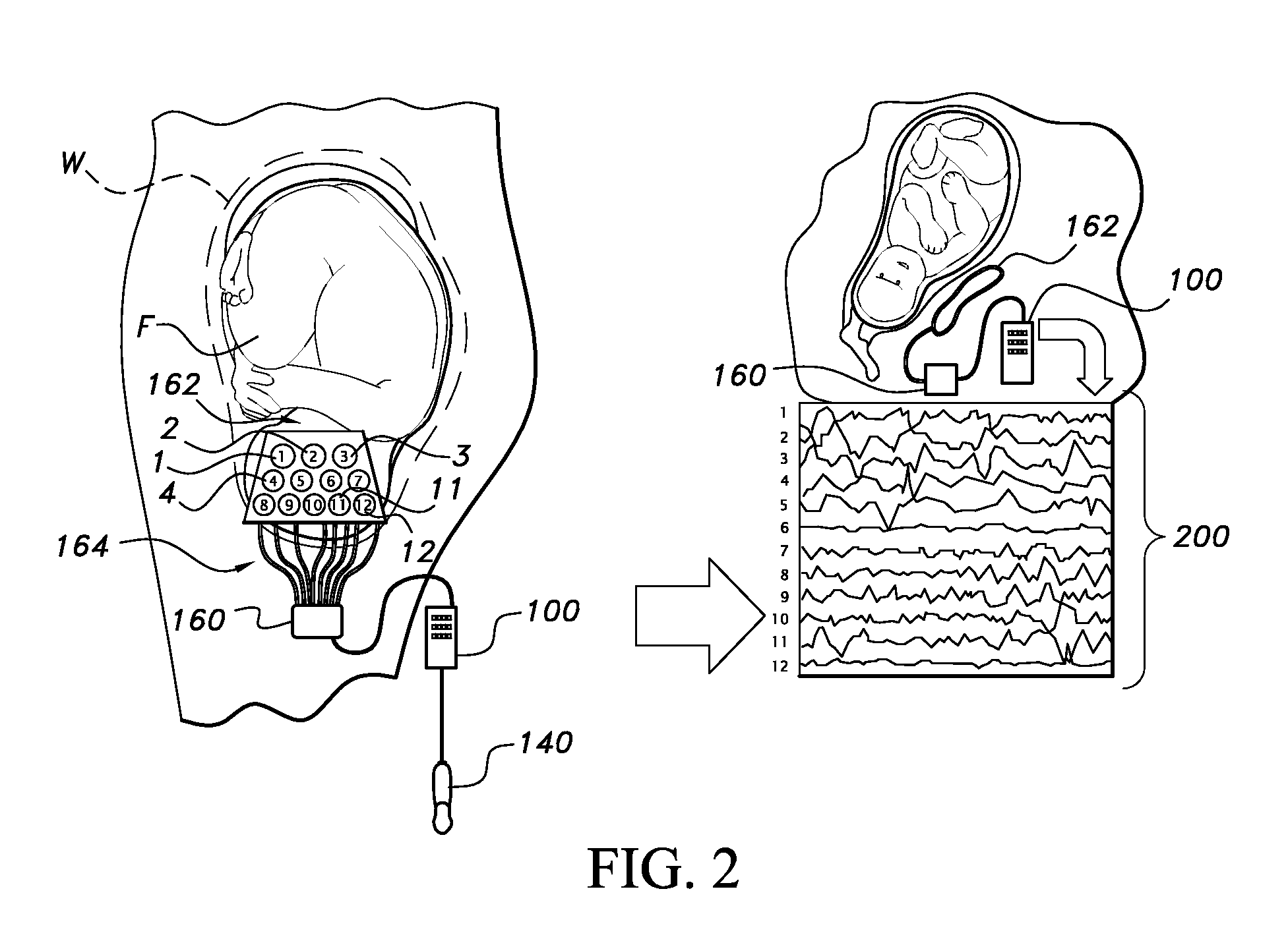 Device for recording ultrasound-induced fetal eeg, and method of use