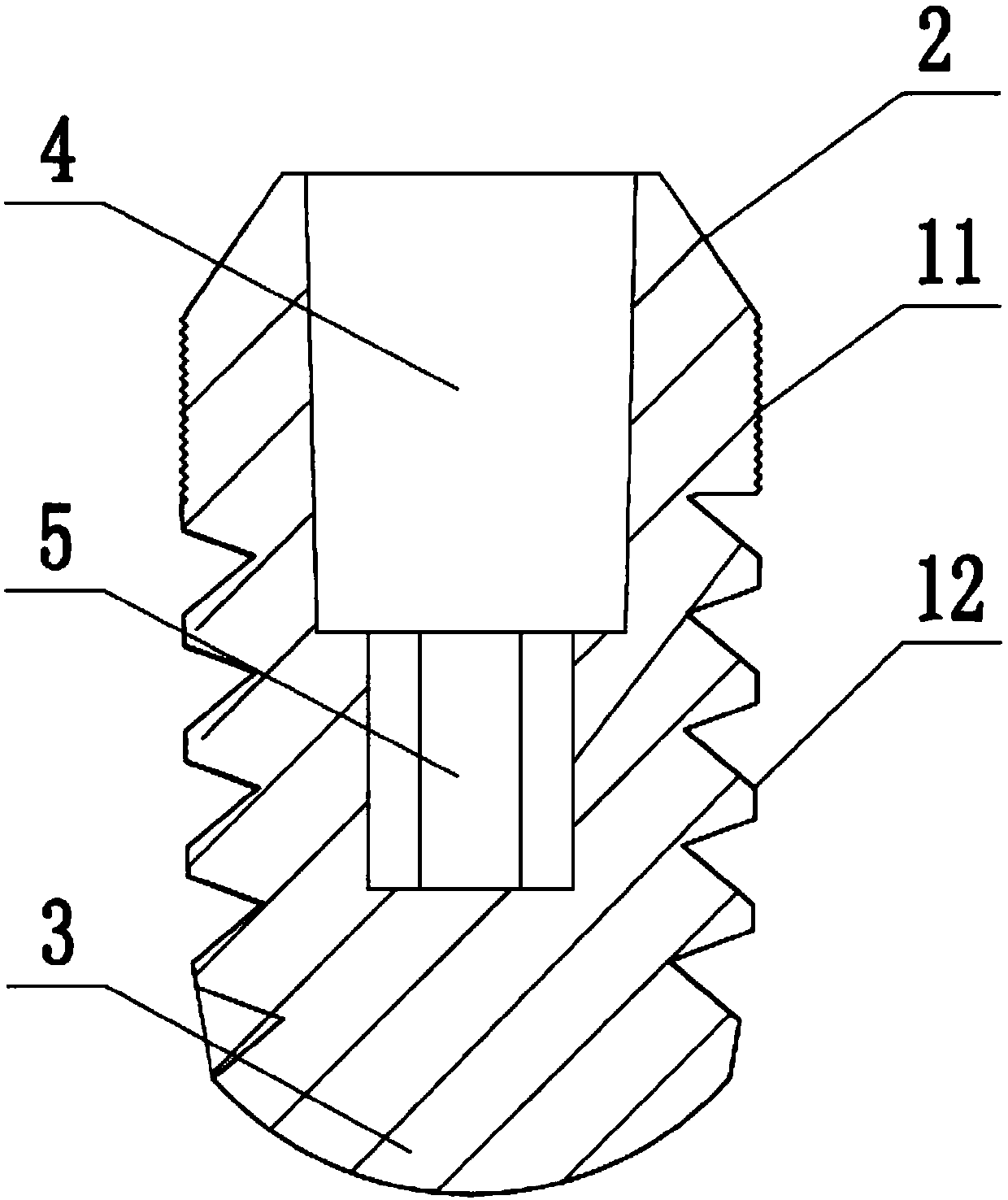 Oral implant