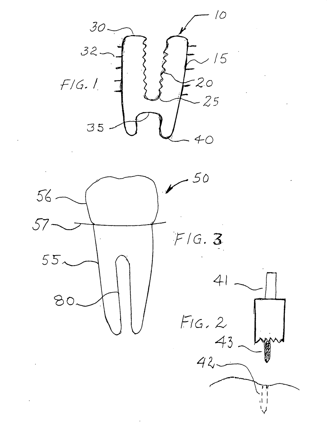 Anchoring system for prosthetics
