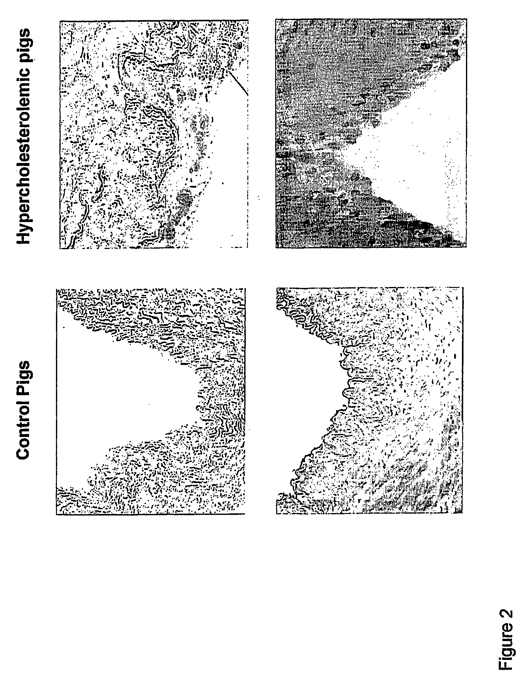 Methods and composition for identifying therapeutic agents of atherosclerotic plaque lesions
