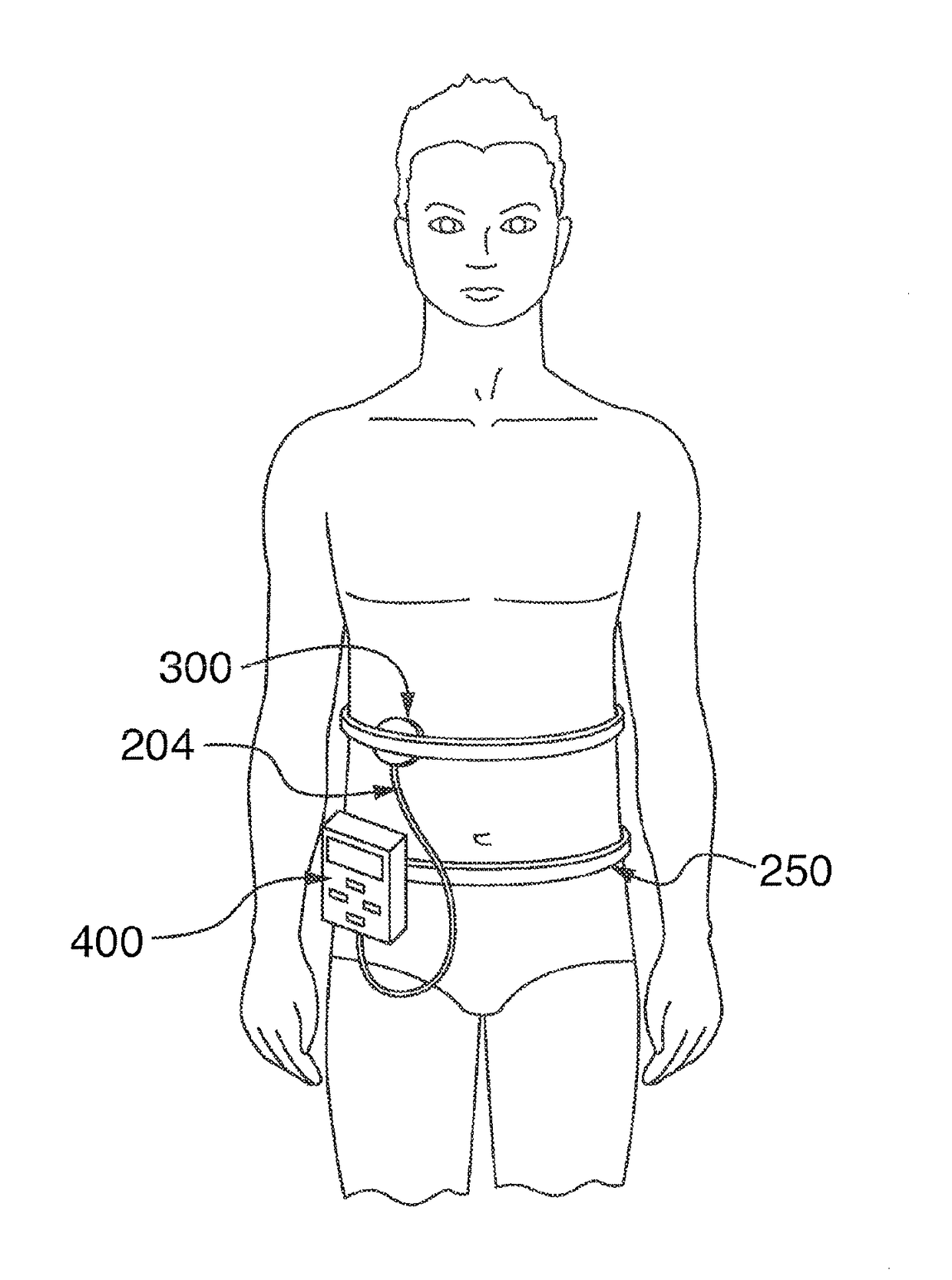 Modified transdermal delivery device or patch and method of delivering insulin from said modified transdermal delivery device