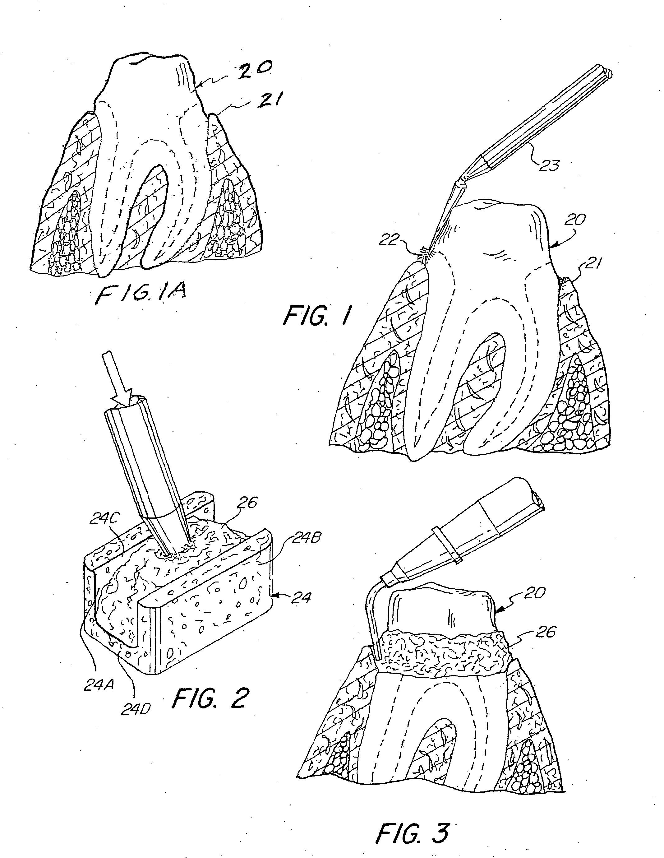 Preloaded dental cap and retraction material for gingival tissue retraction