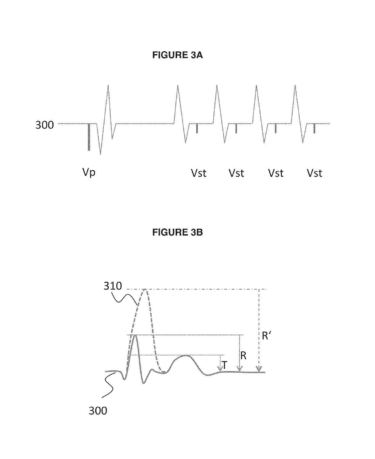 Implantable cardiac system having an R-spike amplifier