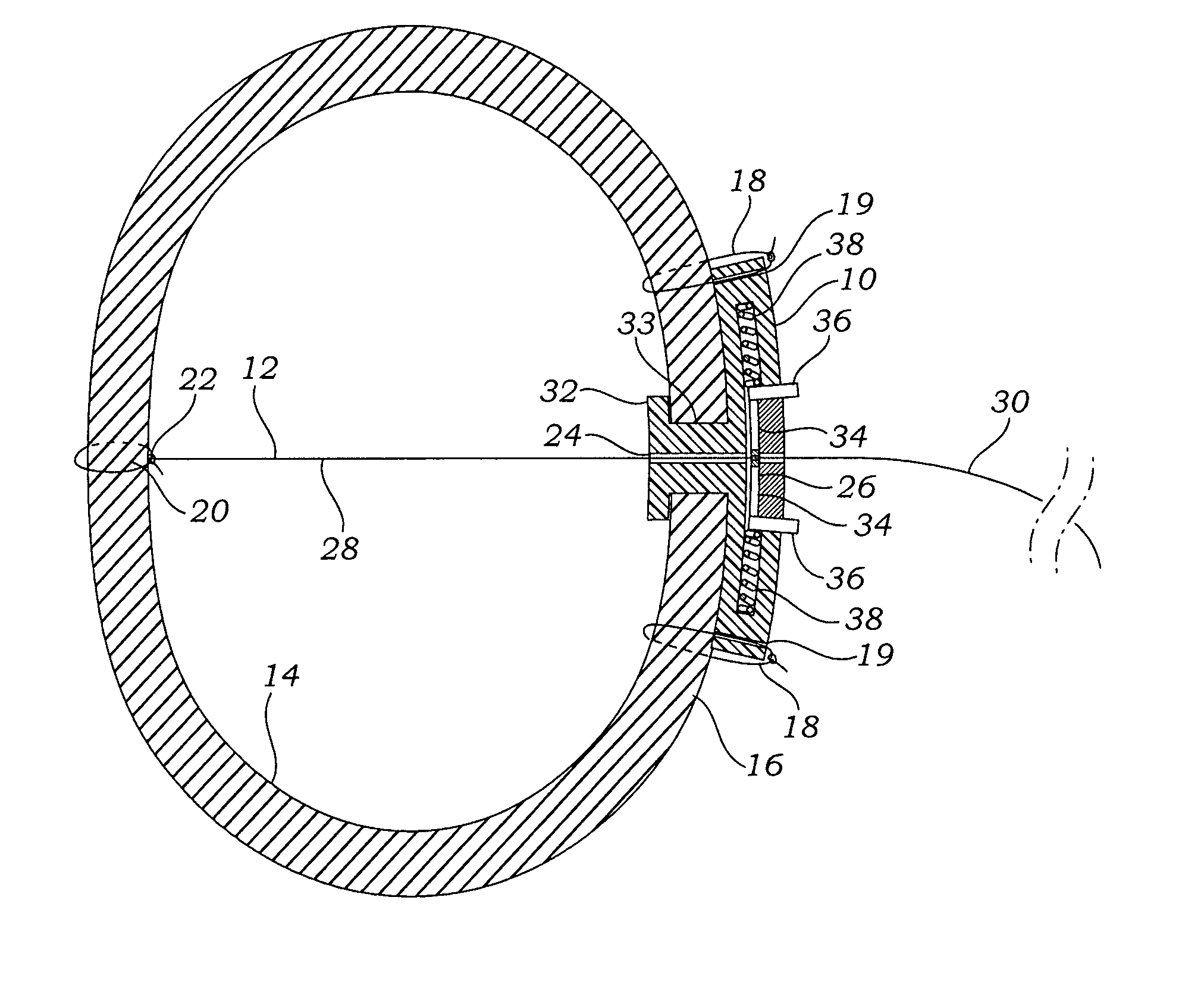 Apparatus, system, and method for applying and adjusting a tensioning element to a hollow body organ