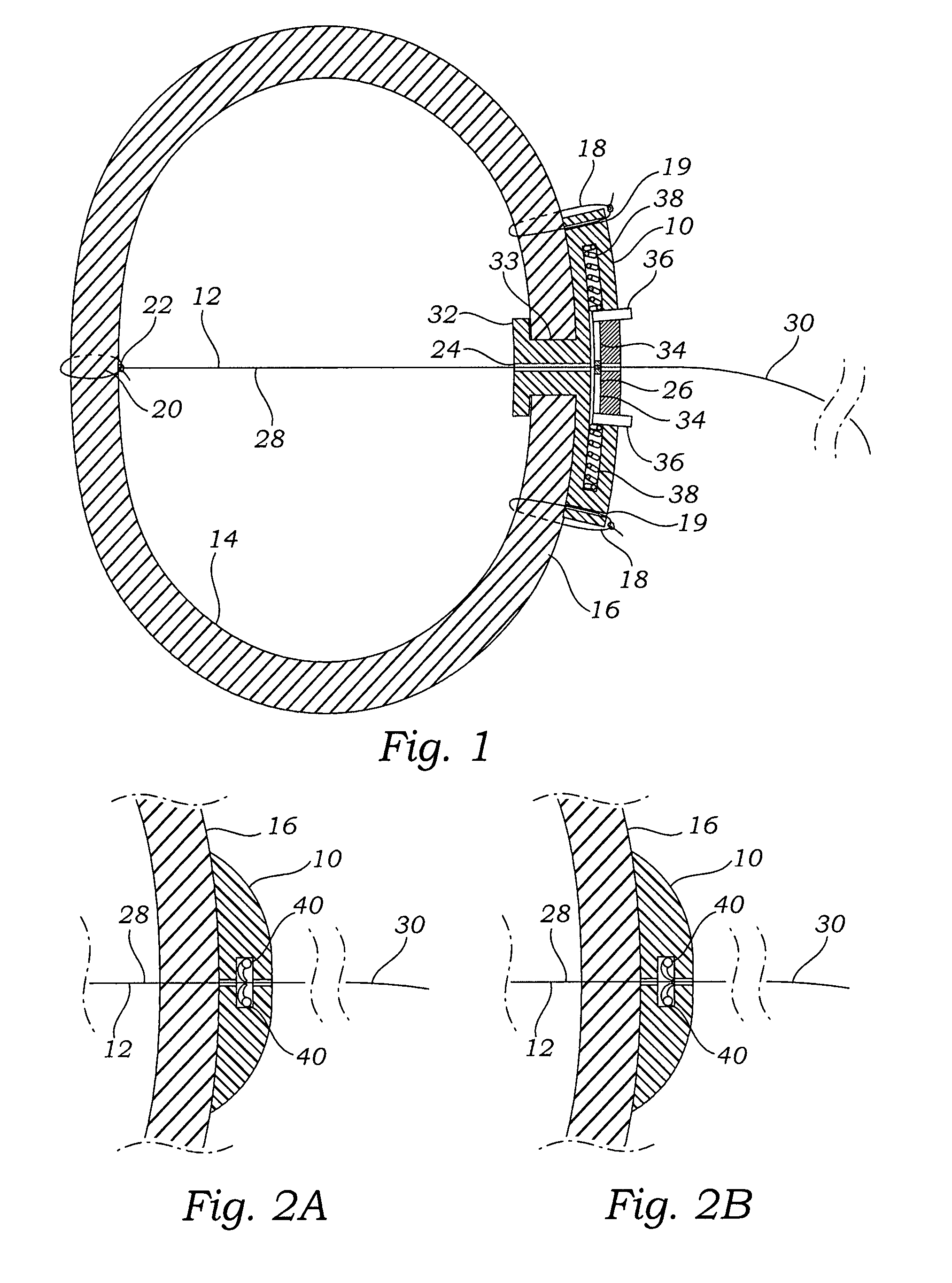 Apparatus, system, and method for applying and adjusting a tensioning element to a hollow body organ