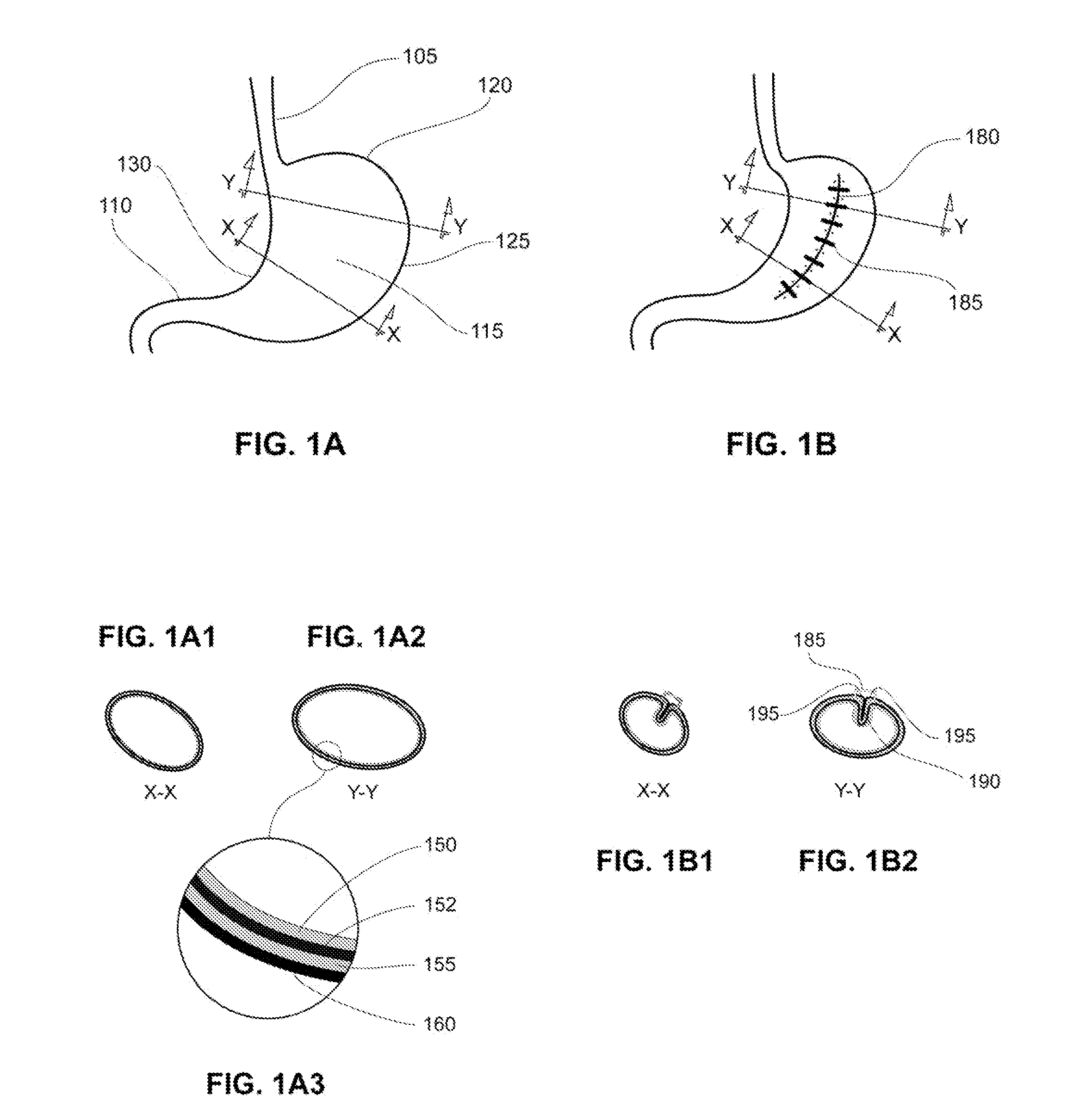 Methods and devices for reducing gastric volume