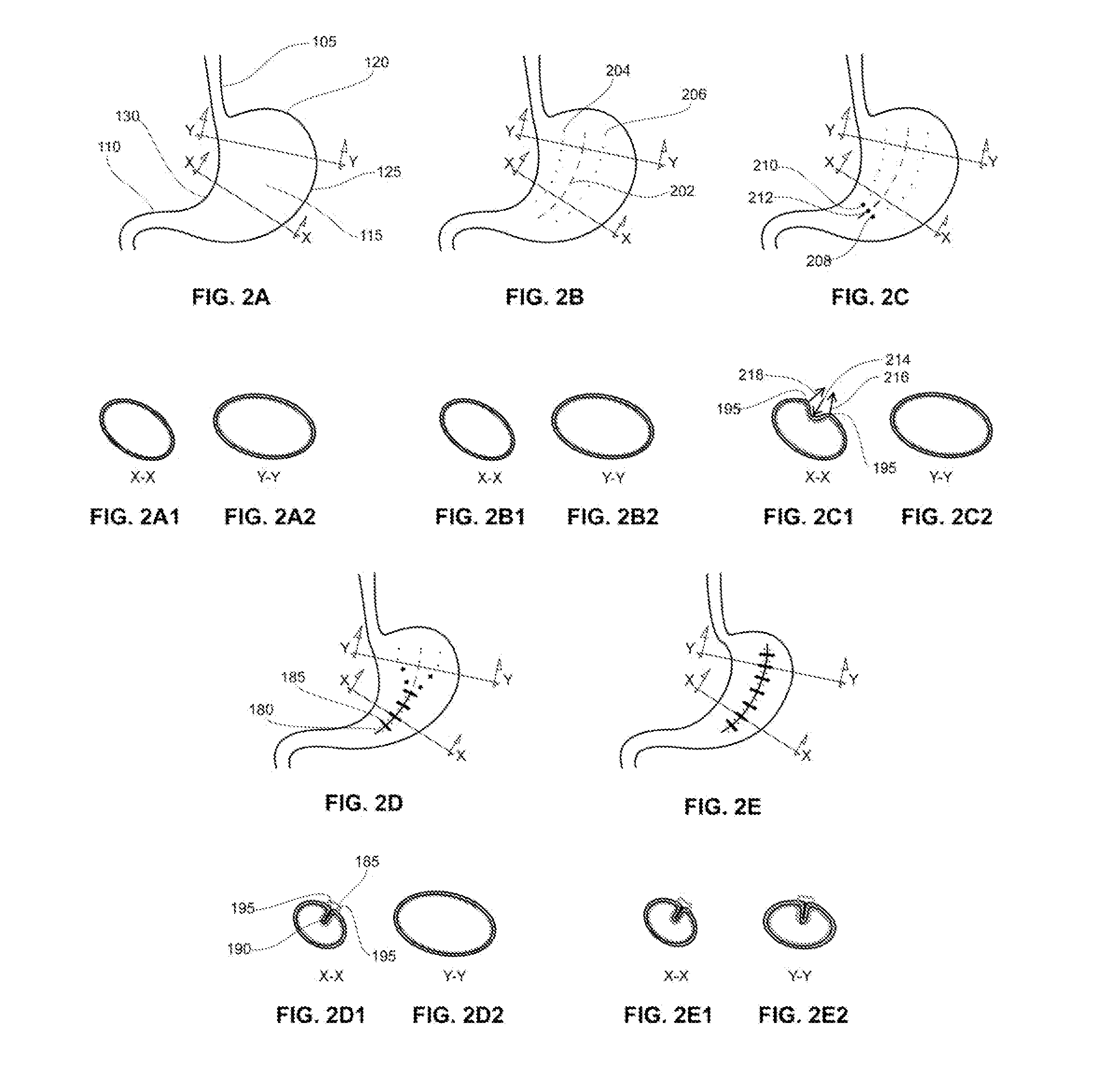 Methods and devices for reducing gastric volume