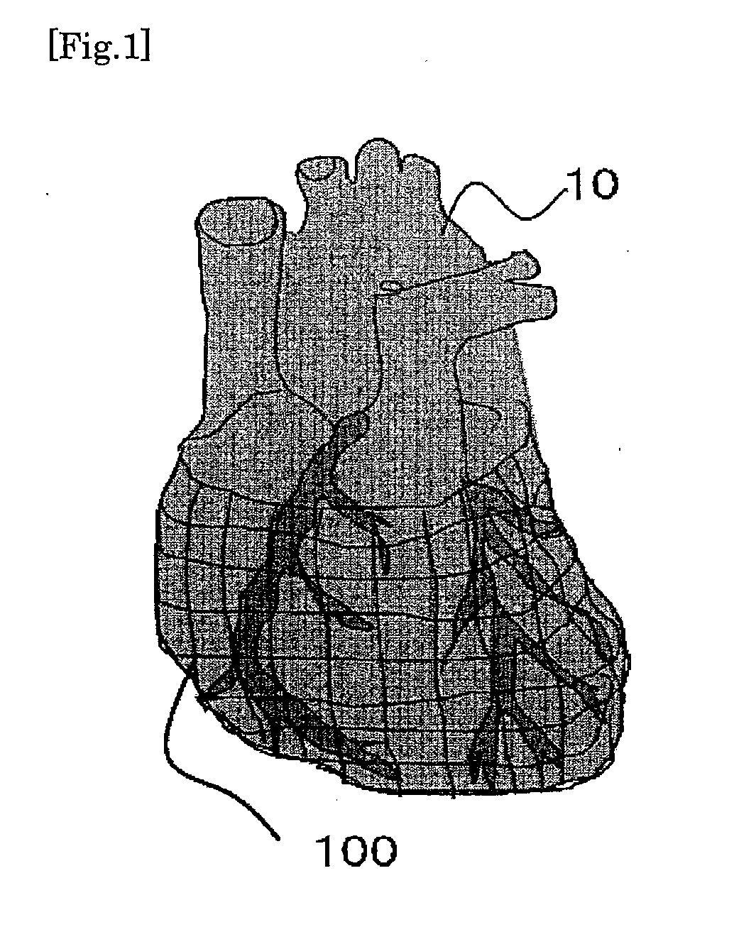 Advanced Heart Failure Treatment Material as Myocardial/Cardiovascular Regeneration Device