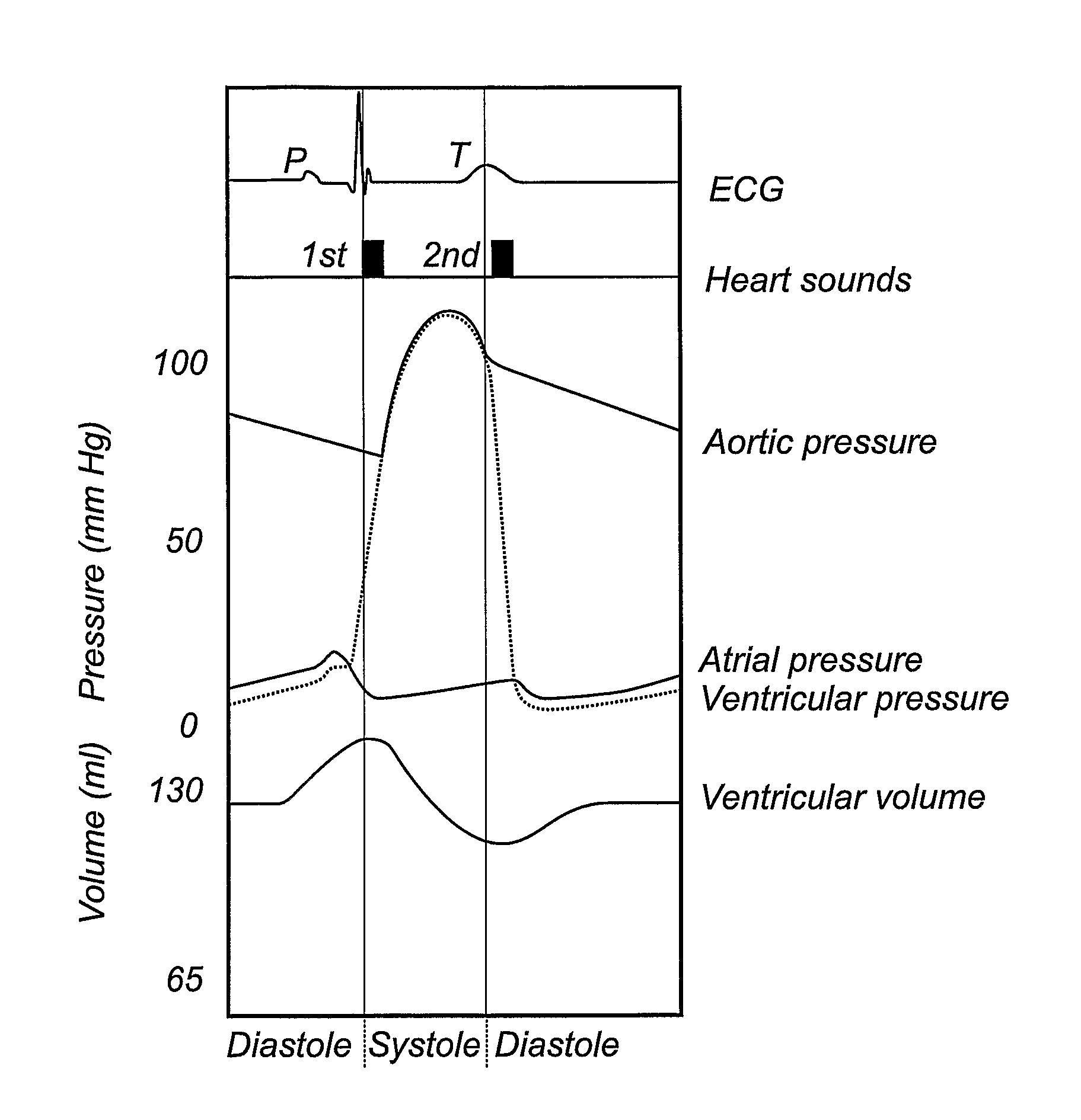 Method, device, implantable stimulator and dual chamber cardiac therapy system