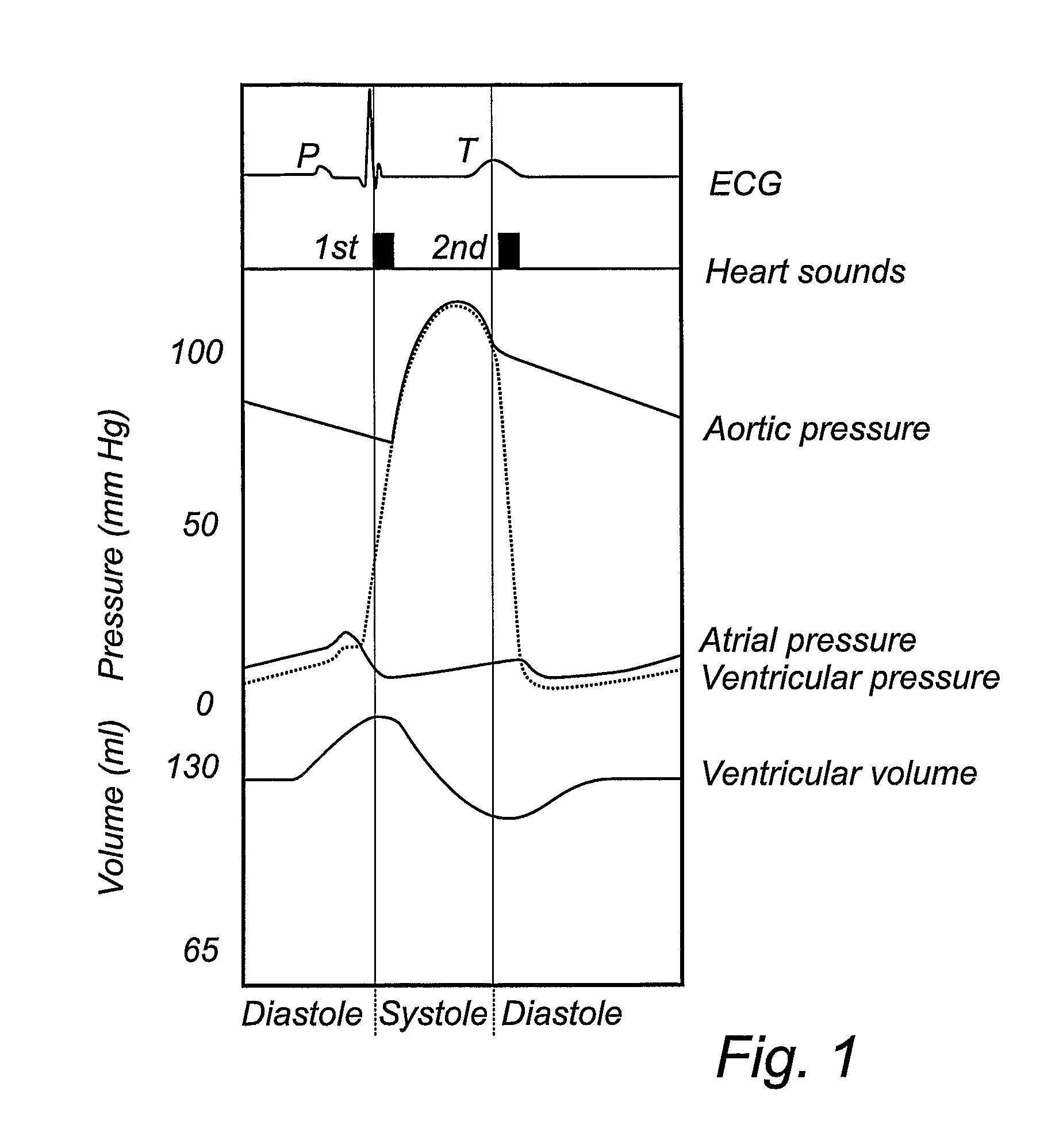 Method, device, implantable stimulator and dual chamber cardiac therapy system