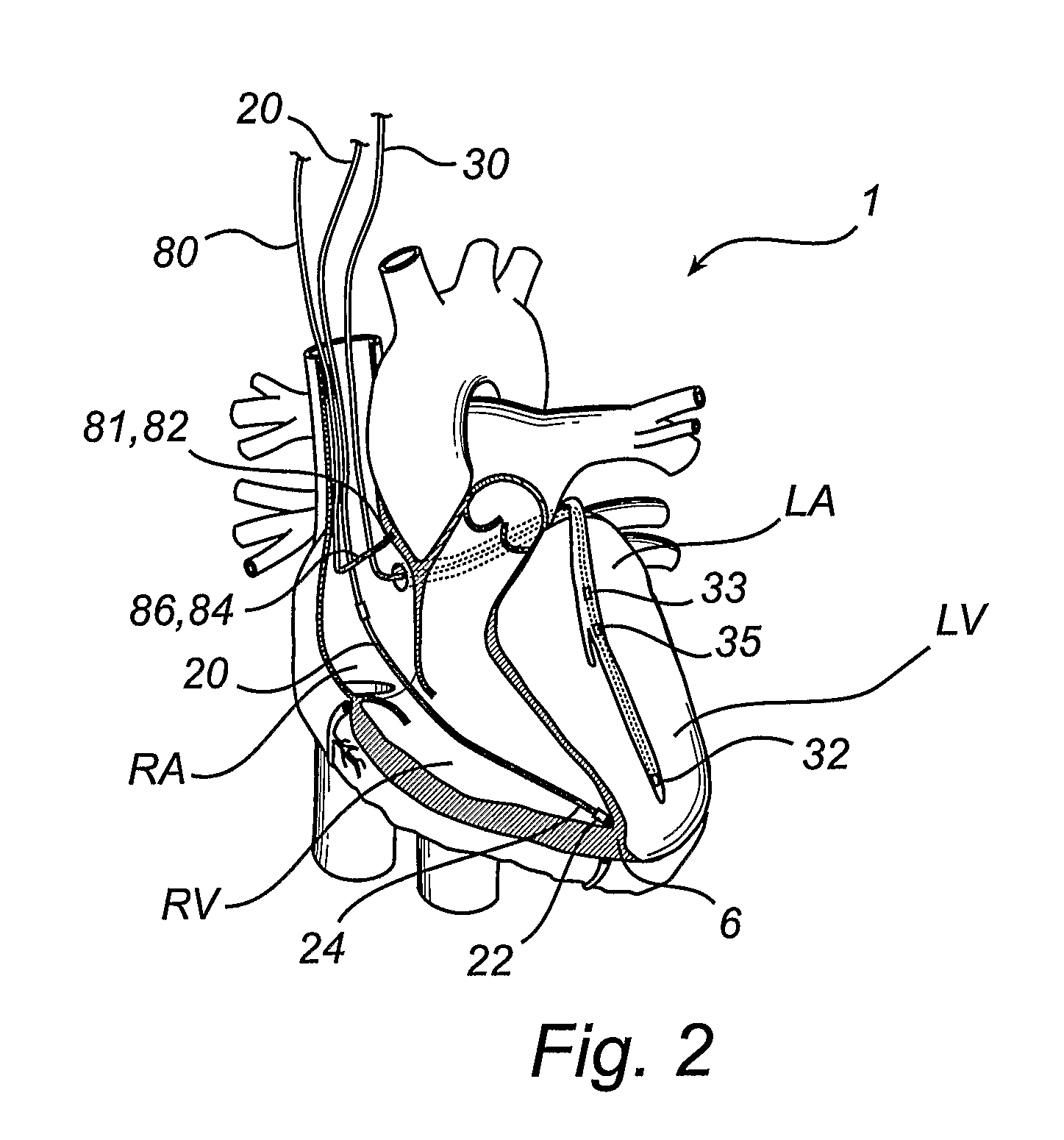 Method, device, implantable stimulator and dual chamber cardiac therapy system