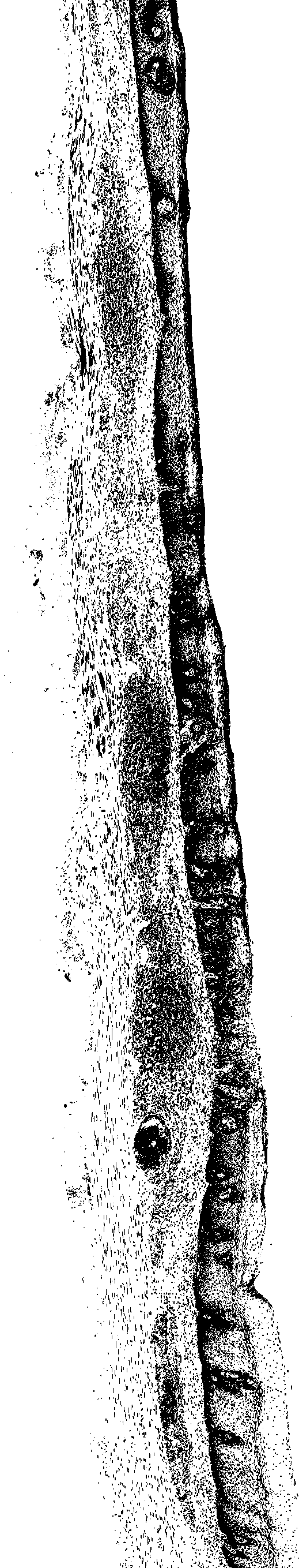 Method for segmenting epithelial tissue in esophageal pathological image