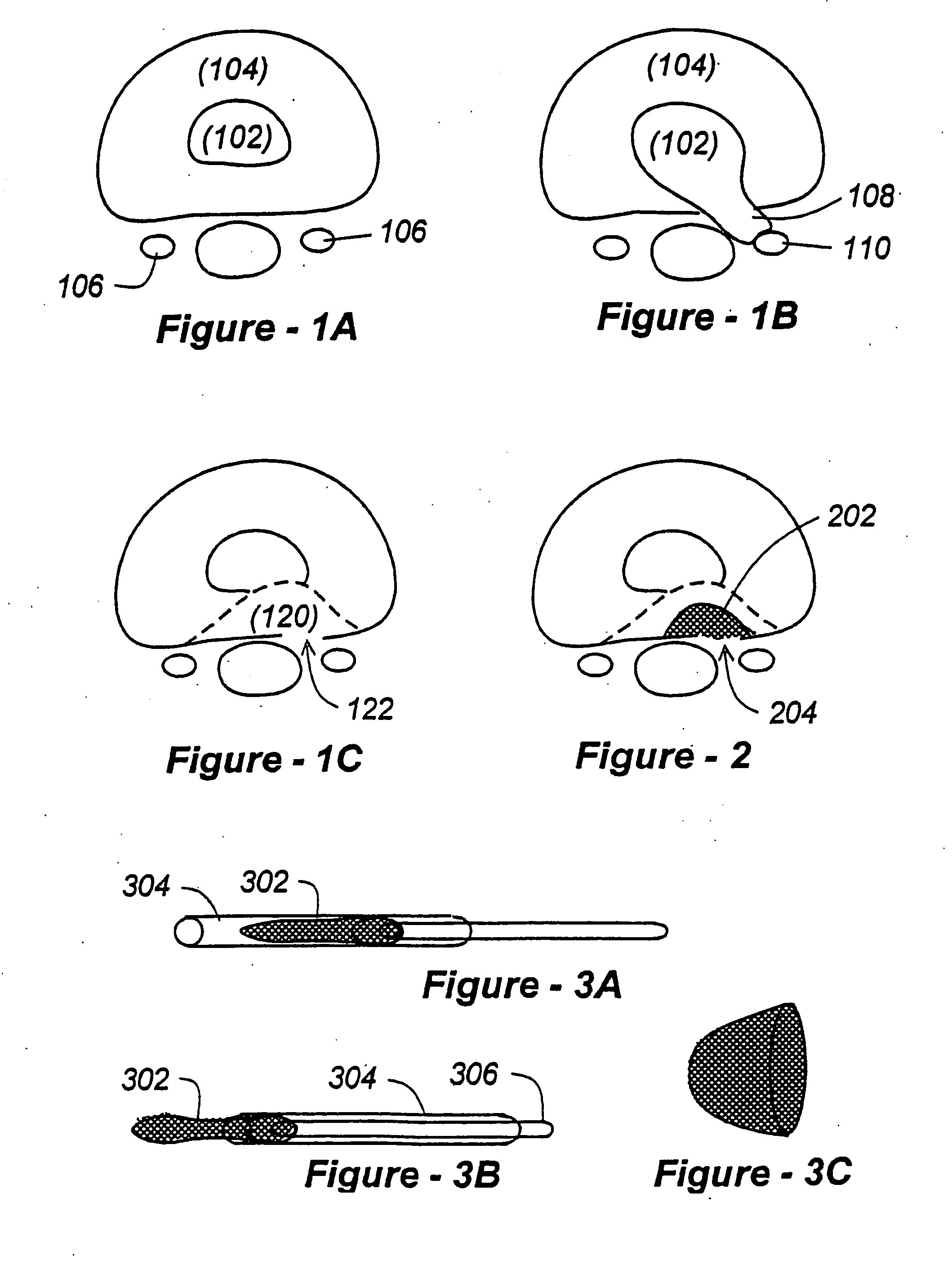 Methods and apparatus for treating disc herniation and preventing the extrusion of interbody bone graft