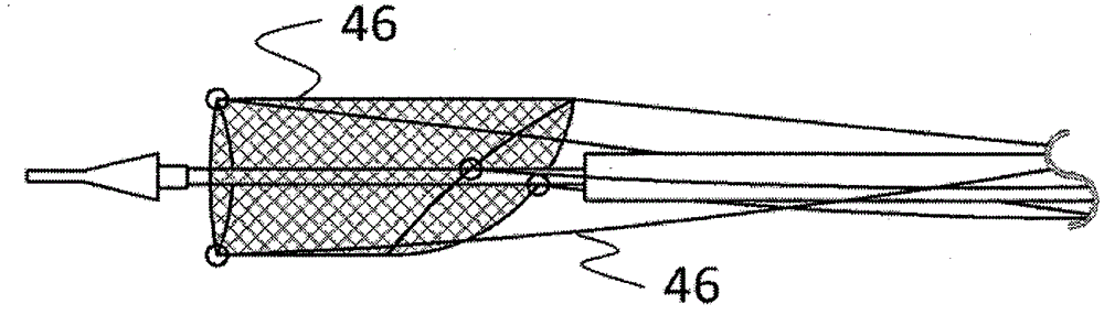 Percutaneous aorta bracket or aortic valve bracket system with far-end protection