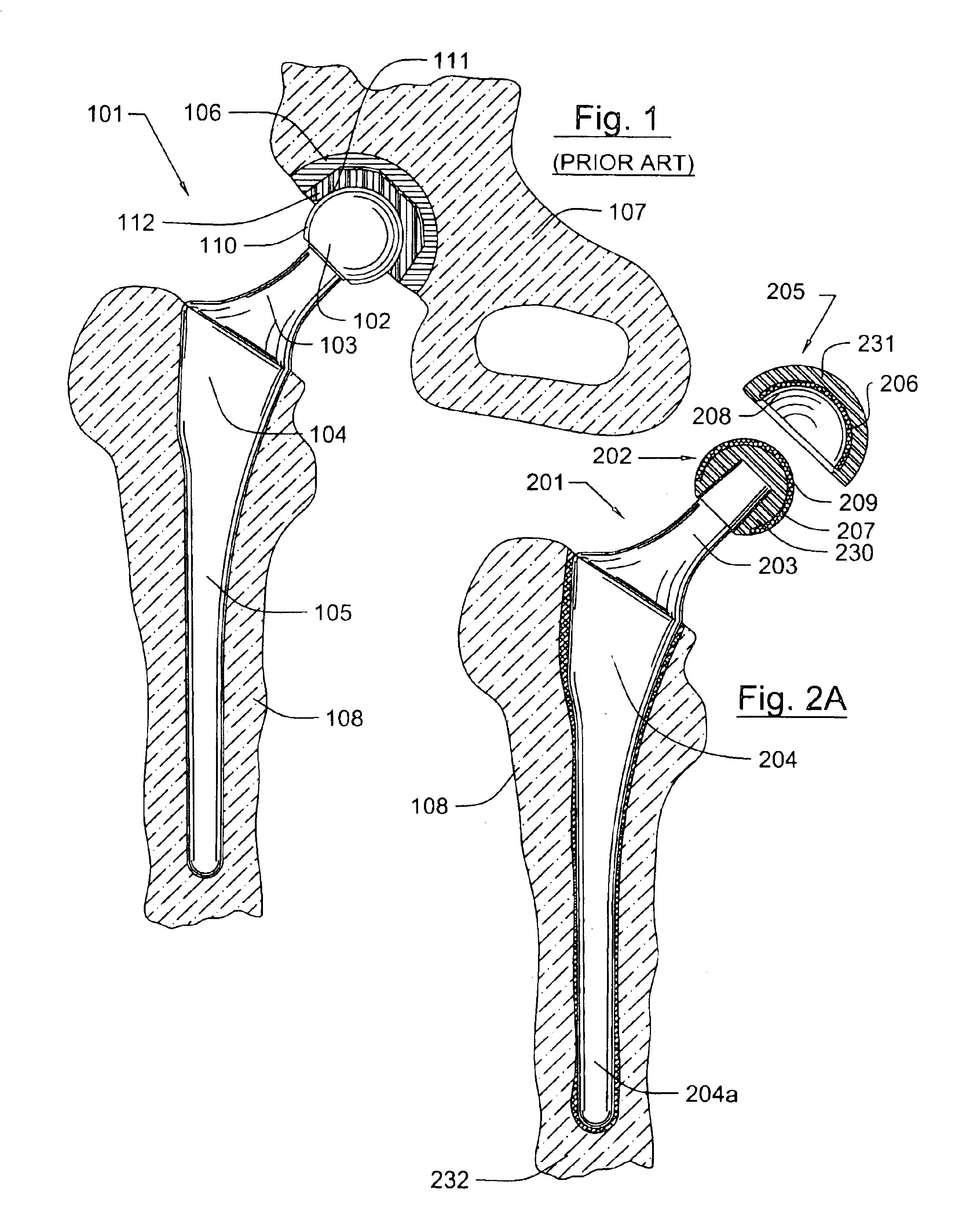 Prosthetic joint component having at least one solid polycrystalline diamond component