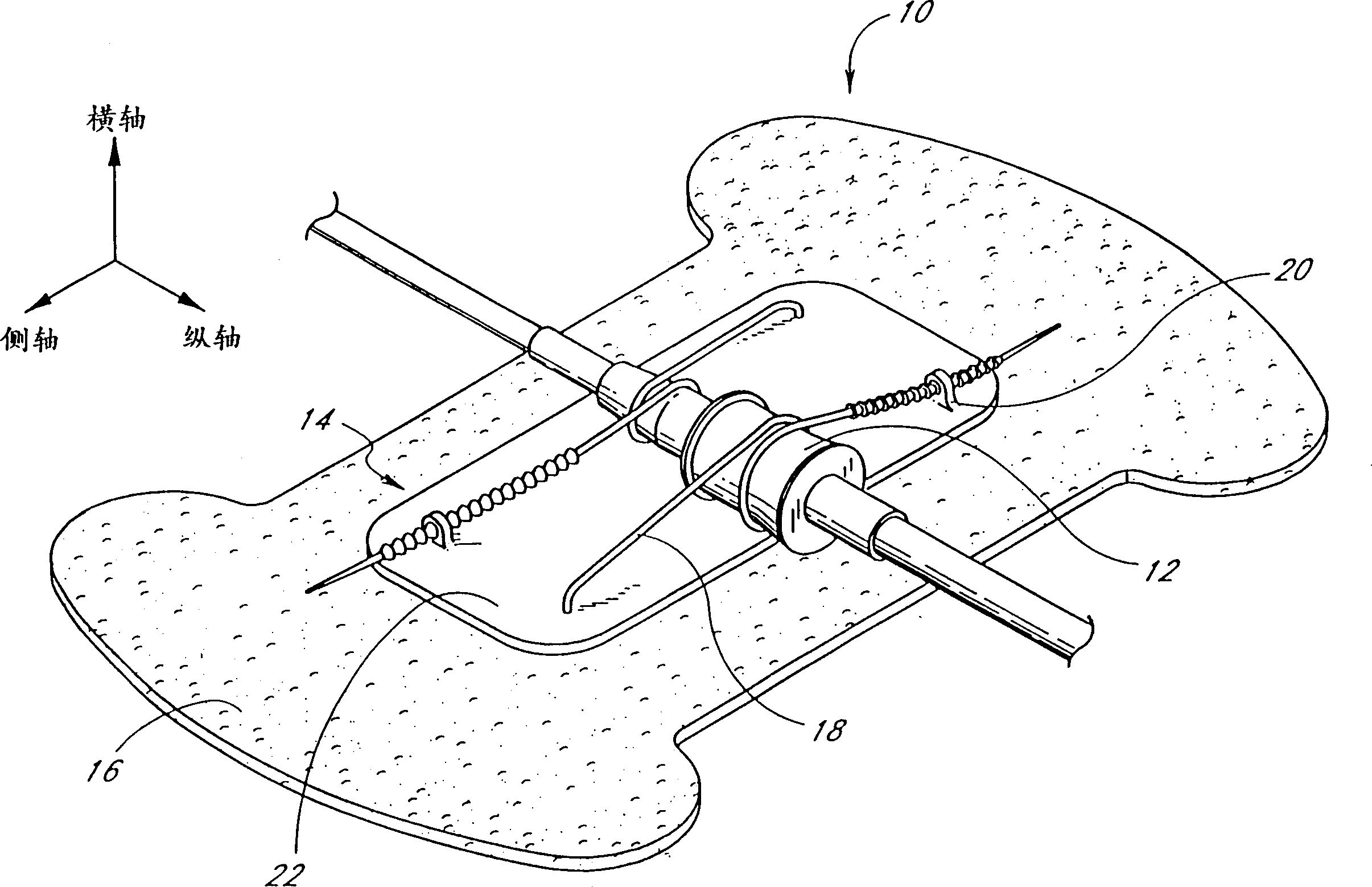 Cathether securement device
