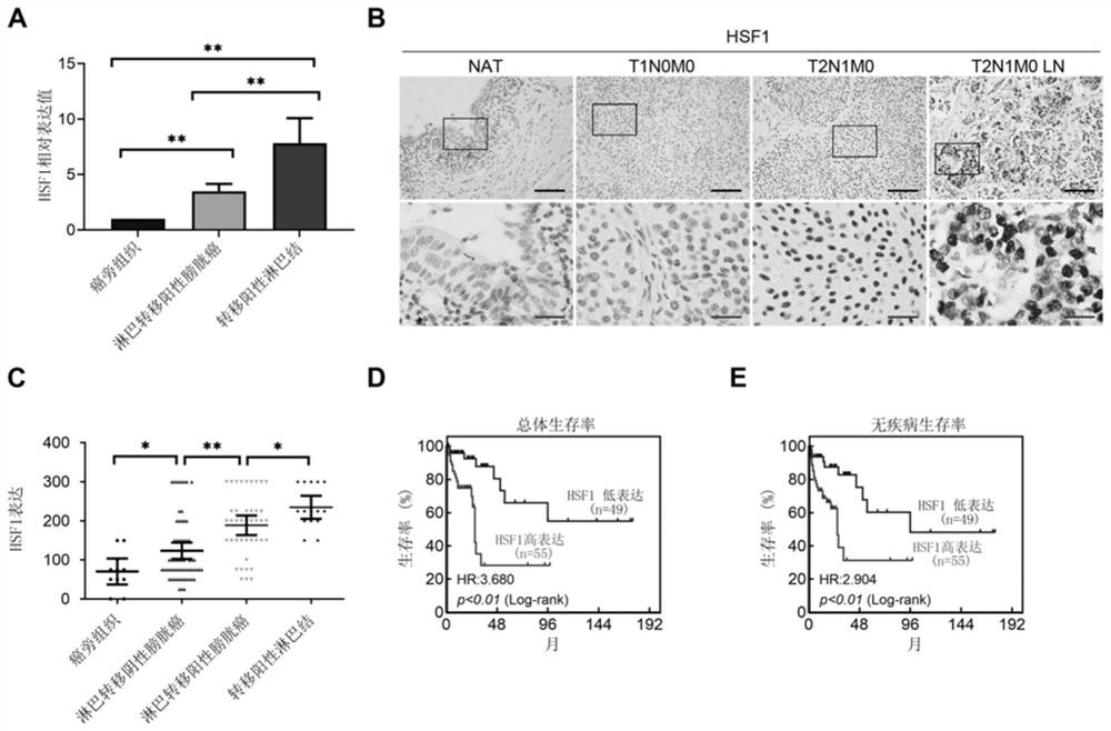 Molecular marker HSF1 for diagnosing and treating bladder cancer and application thereof